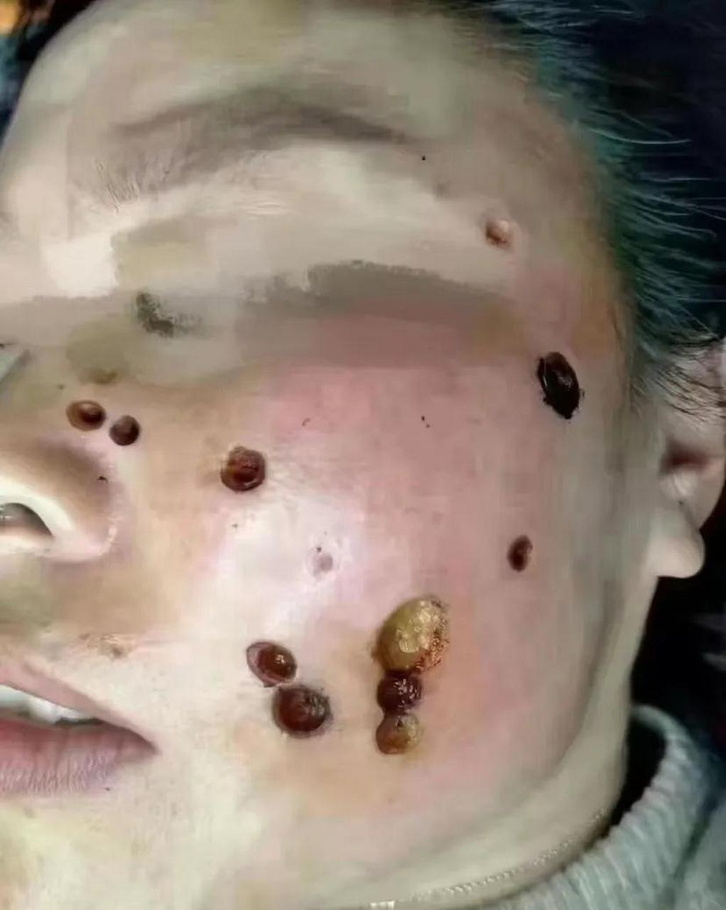 千万不要在网上,直播间乱买药水往脸上涂,什么点痣,祛斑呀!