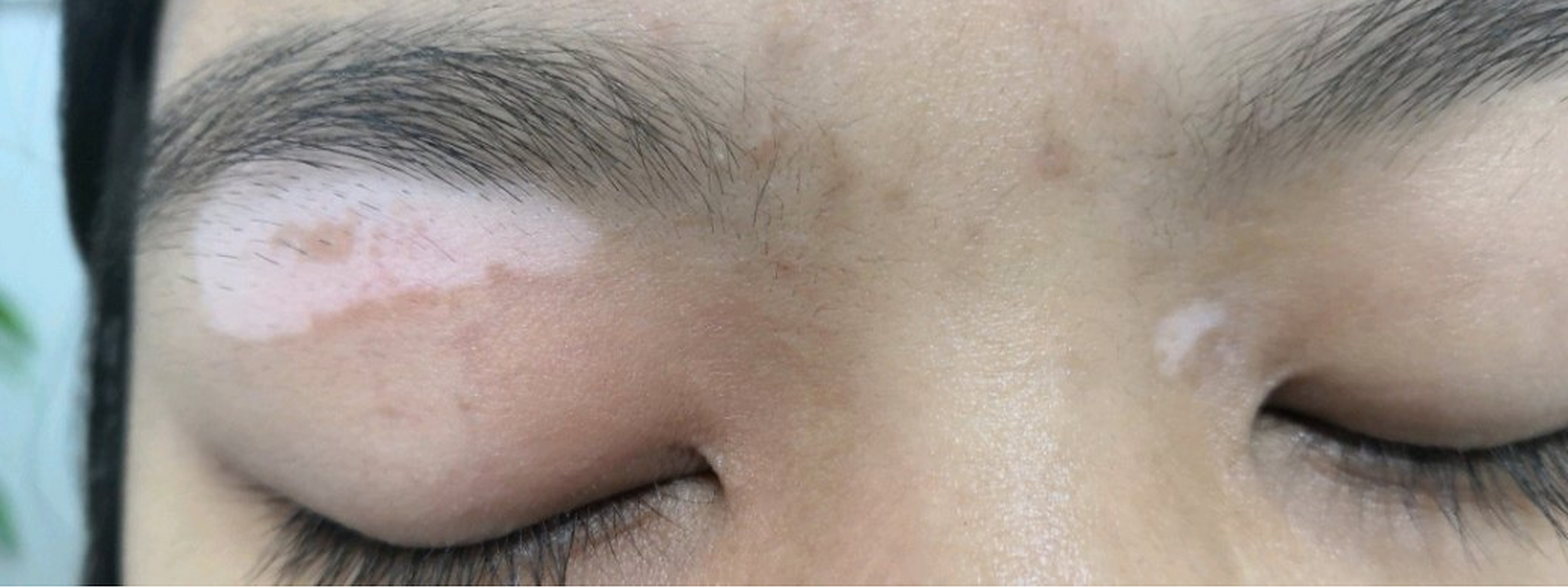 白斑长在眼皮部位,能做手术种植吗?