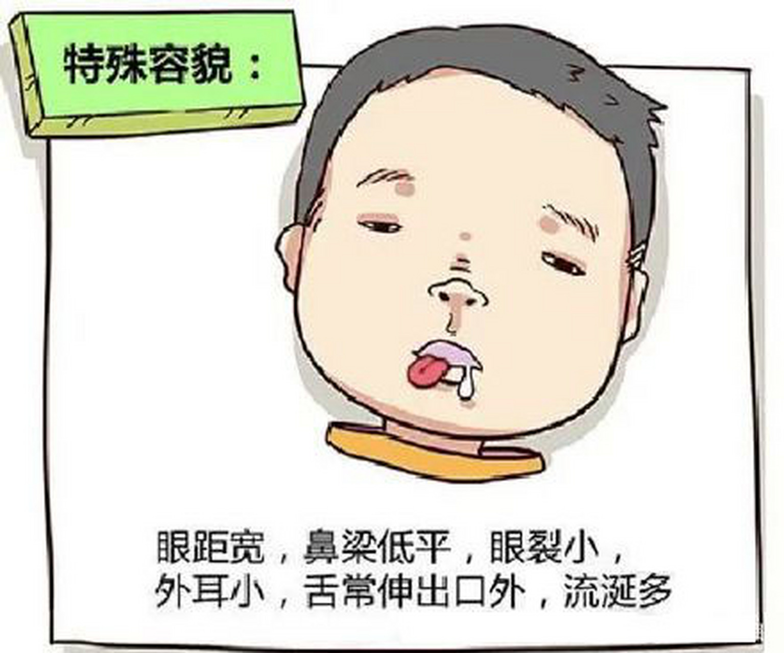 【唐氏综合征也叫21三体综合征】是染色体病,主要表现为智力低下,生长