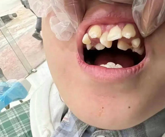 这牙齿还有救吗?牙医都说现在的孩子吃东西太精细了,好多长双重牙的!