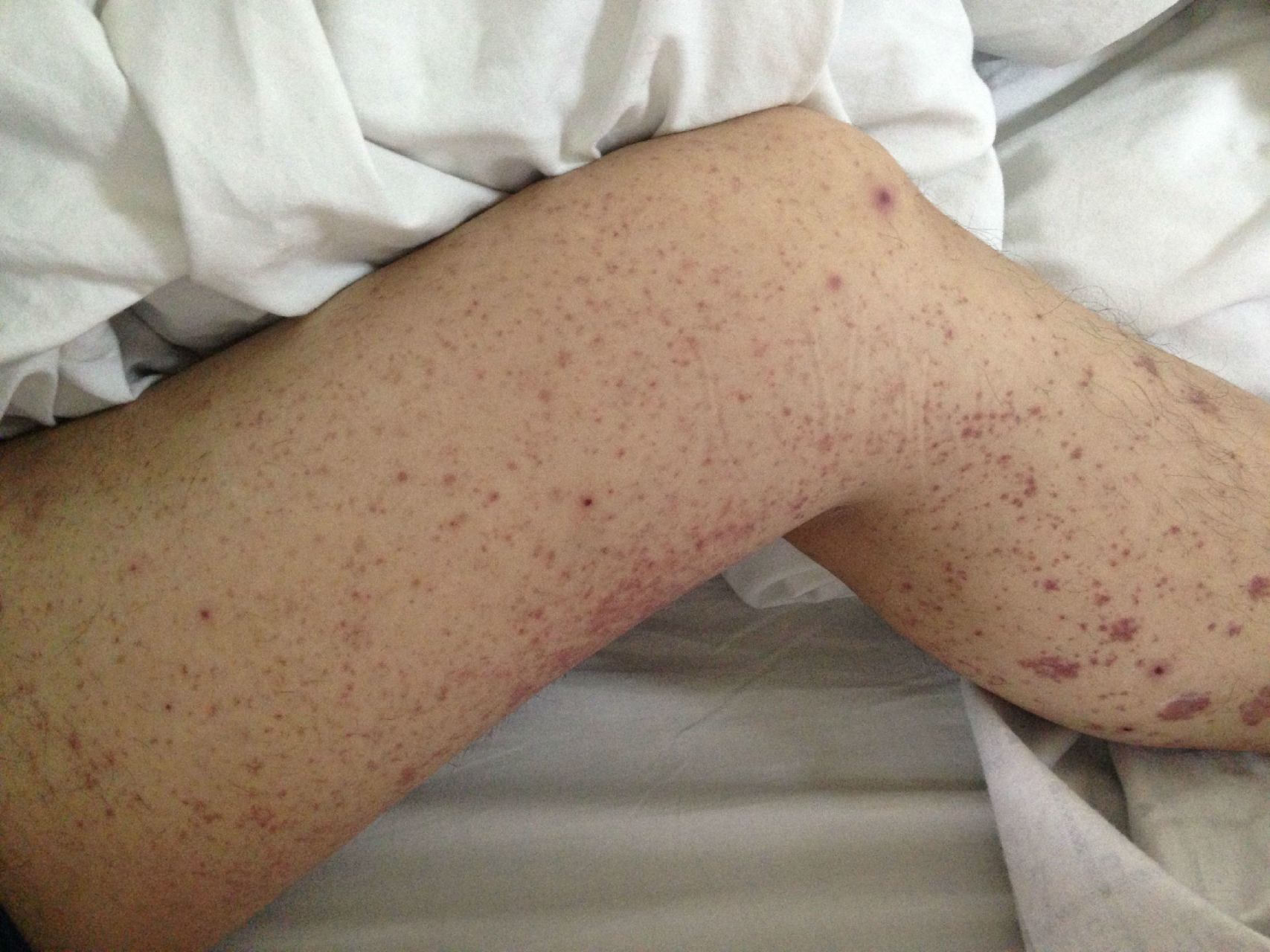 过敏性紫癜性肾炎的7大典型症状!