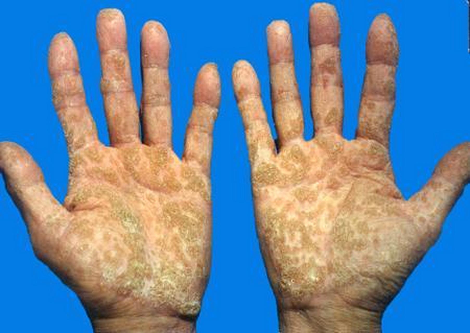 皮肤角化症治疗方法图片