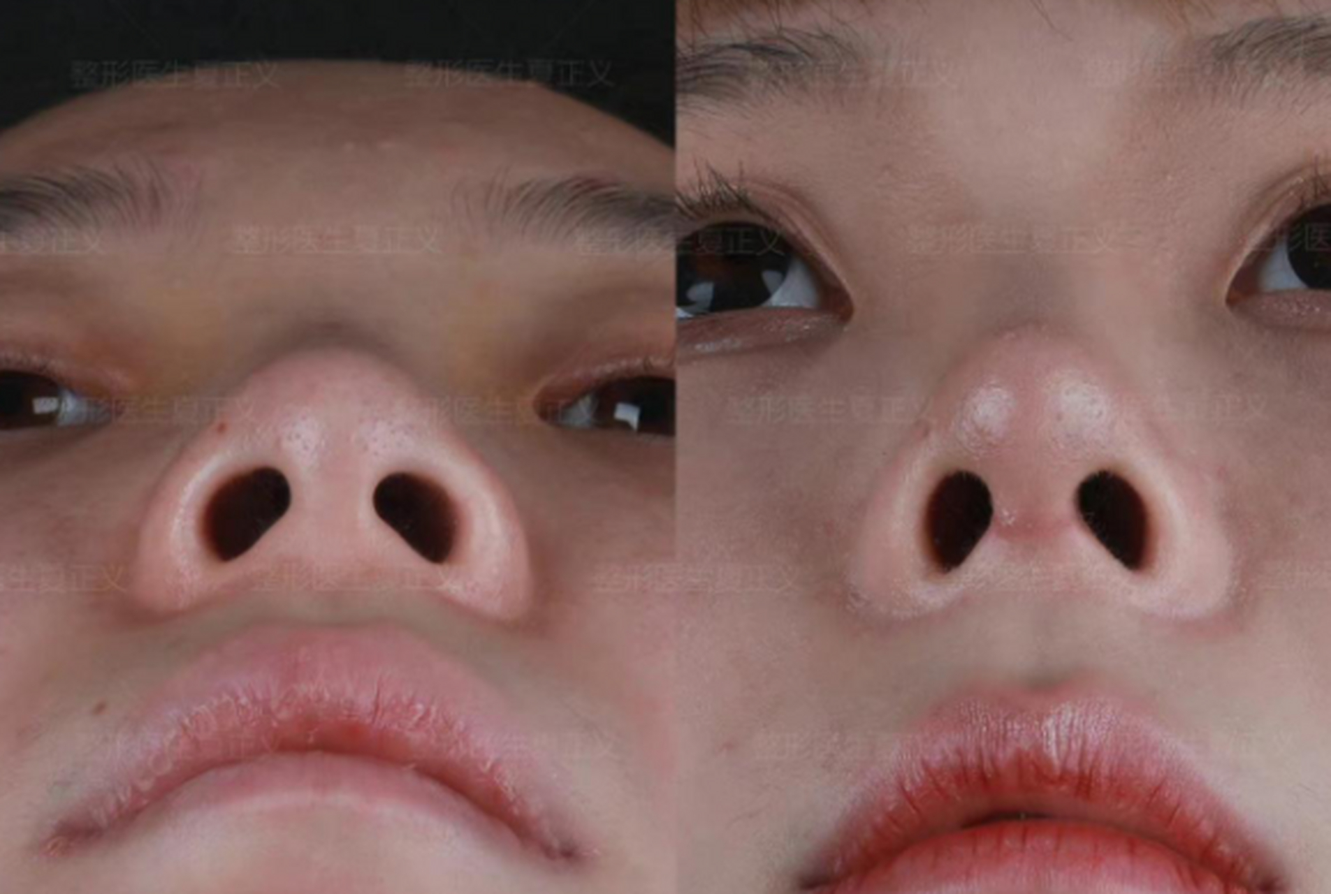 一个好看的鼻子的鼻孔一般都是左右比较对称的,且呈水滴状,不是圆的