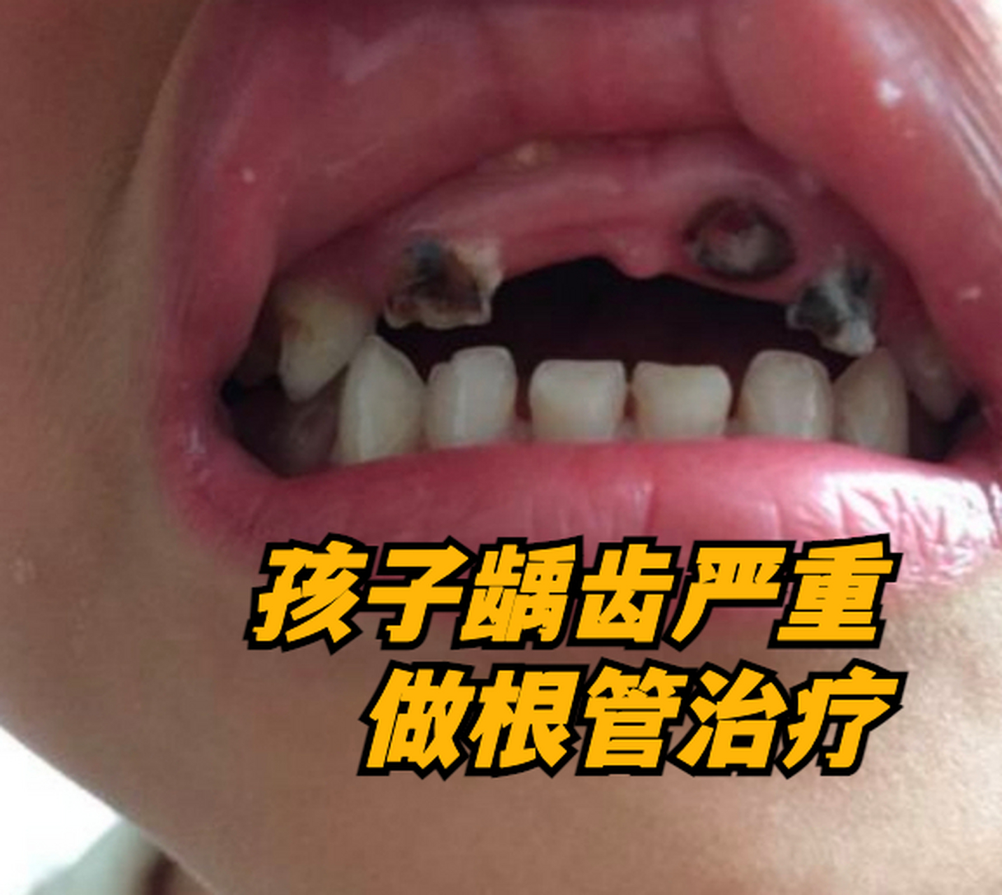 龋齿比较严重,做了氢氧化钙填充 幼儿园老师打电话过来说孩子今天在