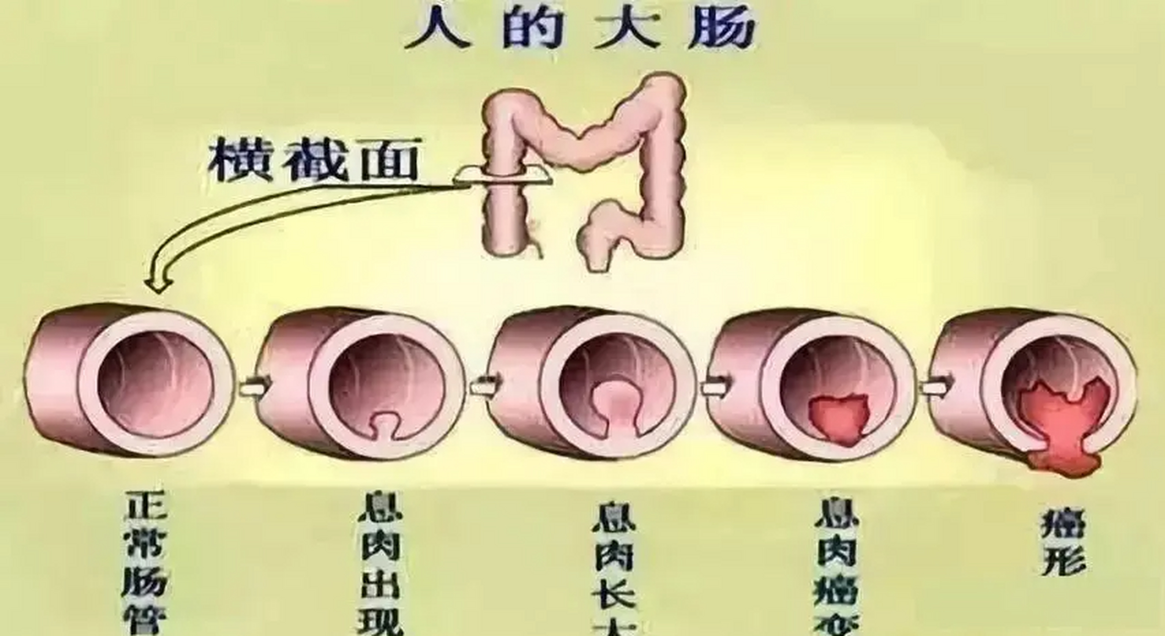 肠息肉有什么症状图片