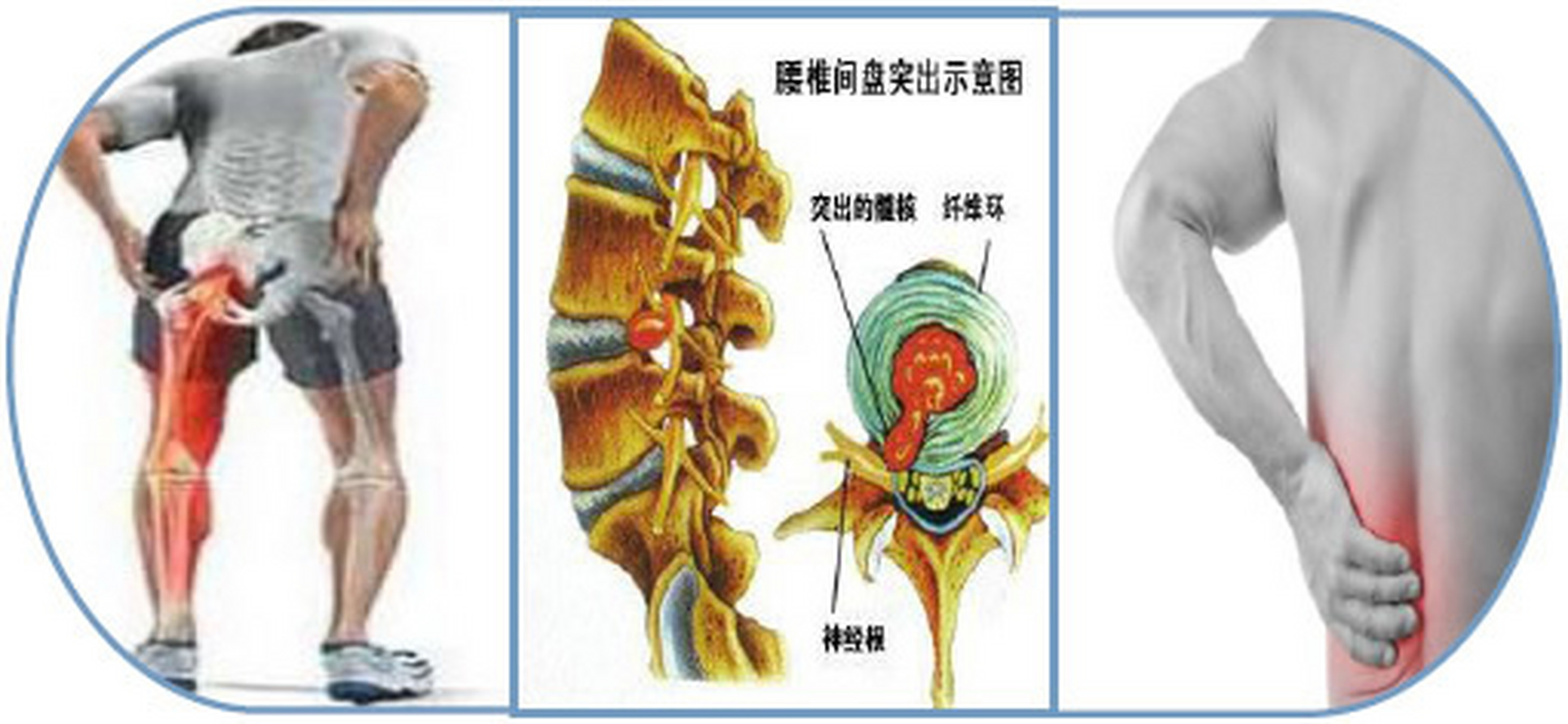 腰间盘突出千万不要就因为腰疼去盲目的做手术 腰椎间盘突出其实没有