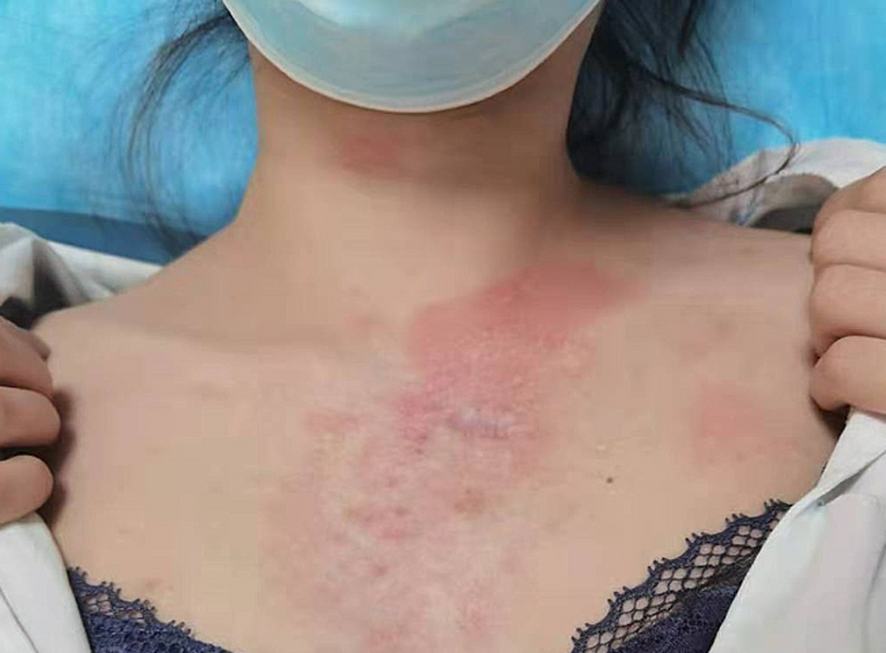 为了止痒,她把瘢痕疙瘩都挠破了.