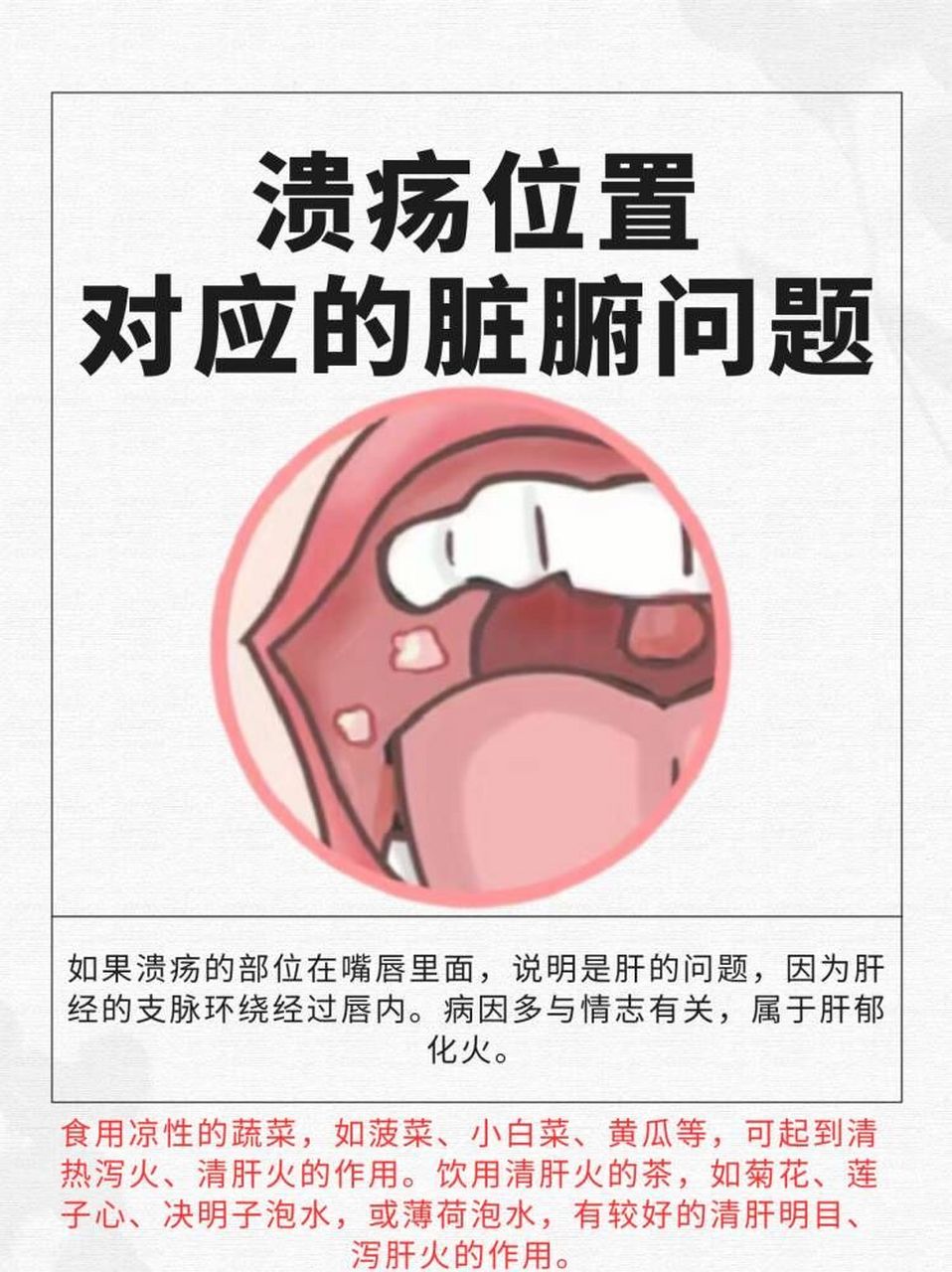 口腔溃疡位置对应图图片