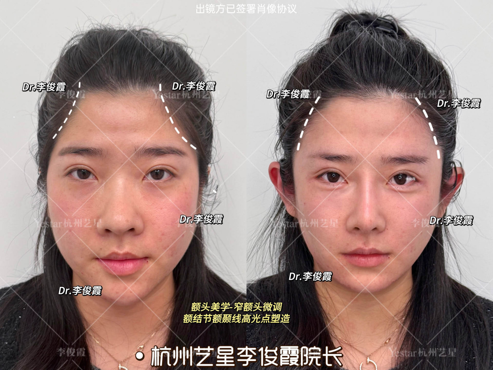 结节 额头光影美学,全脸贵气 抗衰老下垂,额颞线高光点塑造,骨相突出