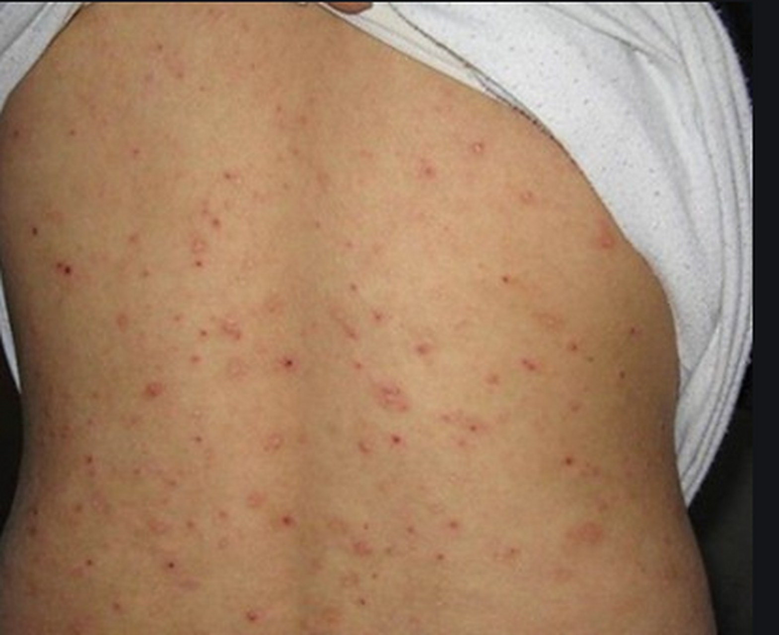 身上突然长出很多米粒大小的小红疙瘩,特别痒,以为是皮肤过敏,就吃了