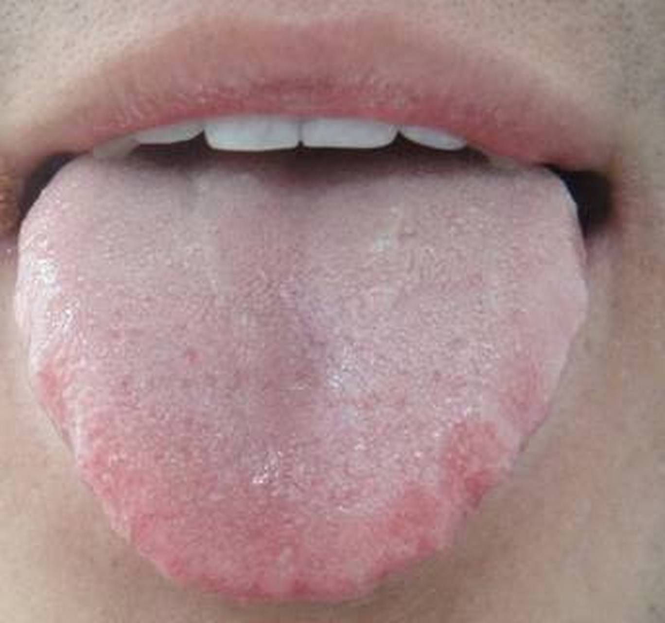 脾虚舌头的症状有图片图片