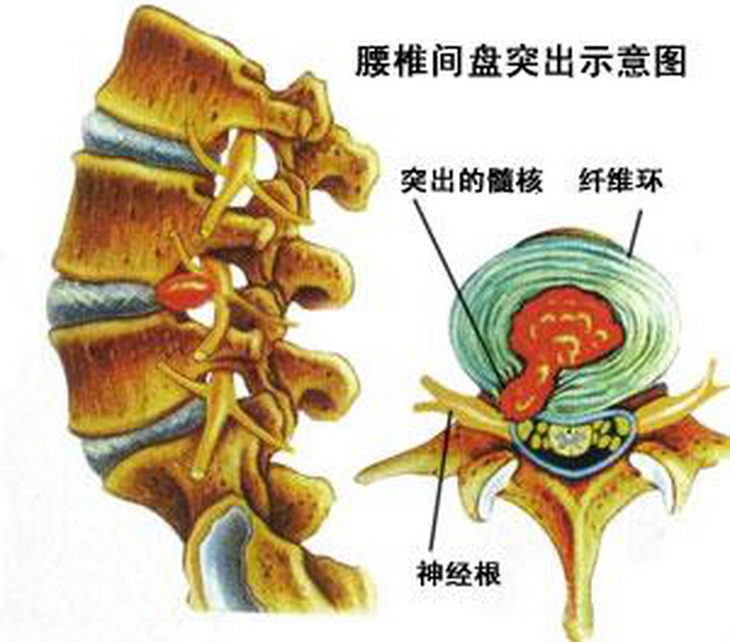 颈椎纤维环图片