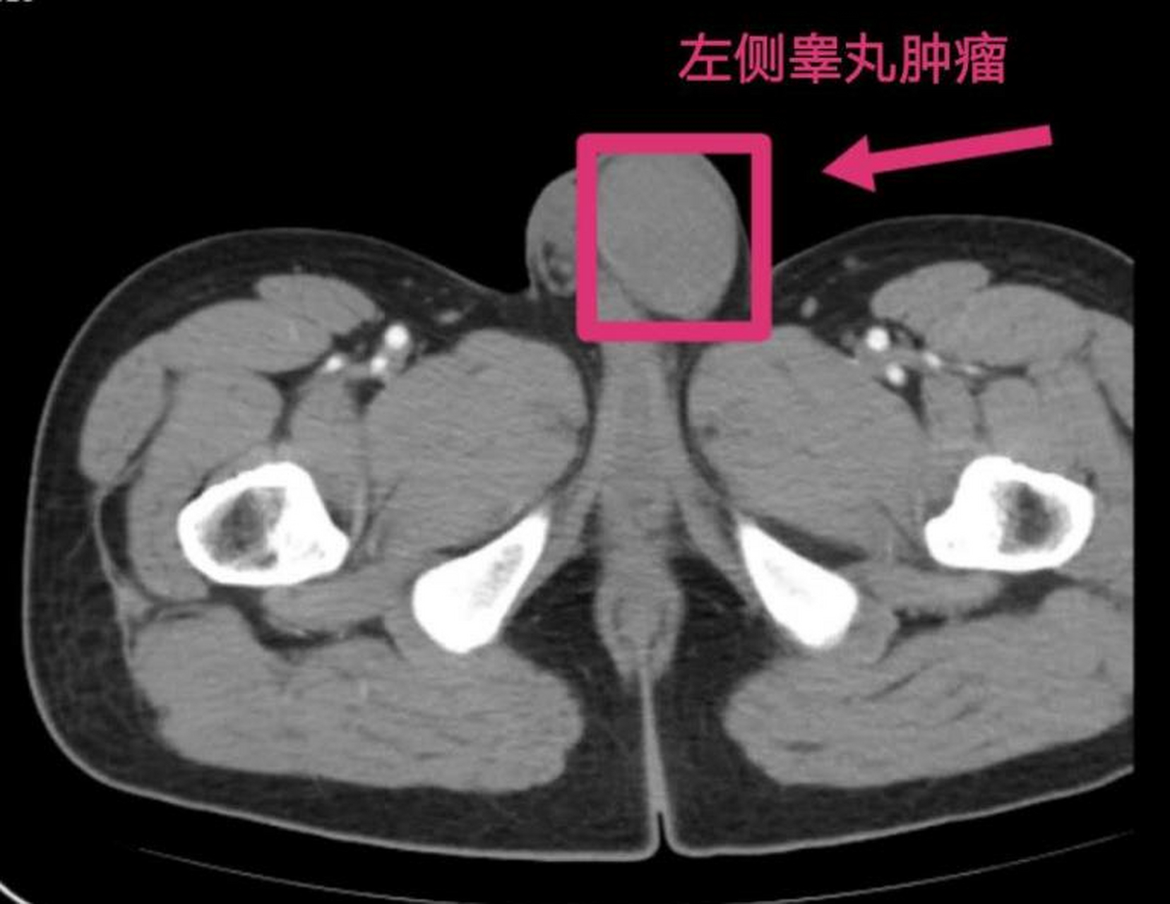 睾丸囊肿左侧图片