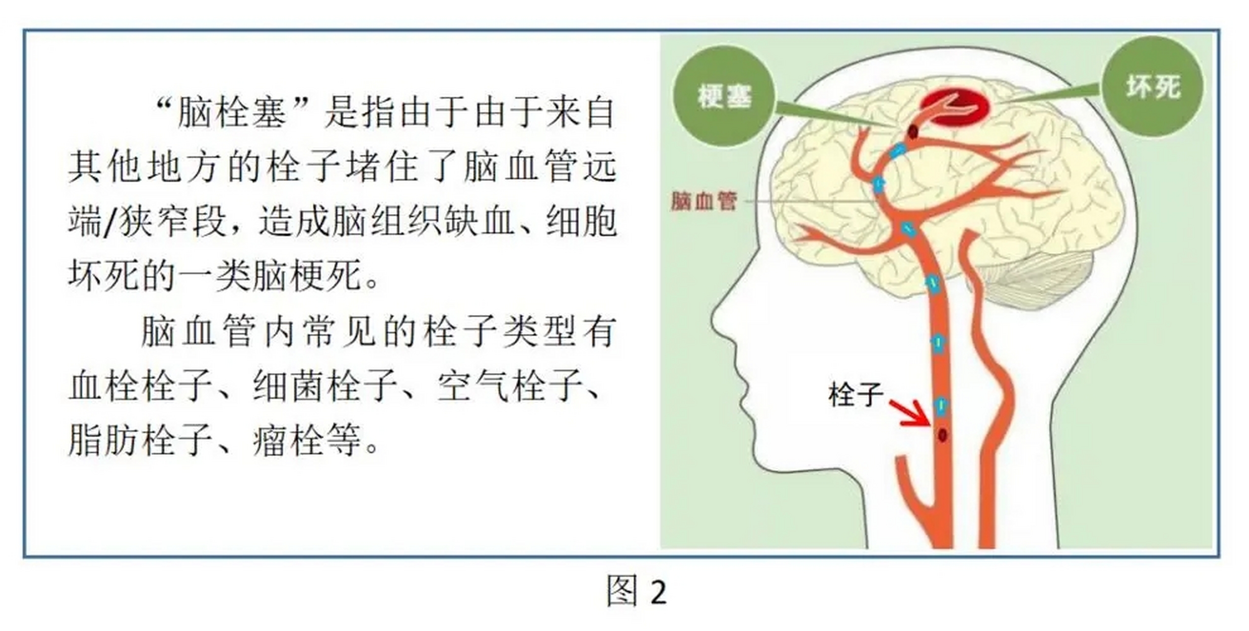 脑梗示意图图片图片