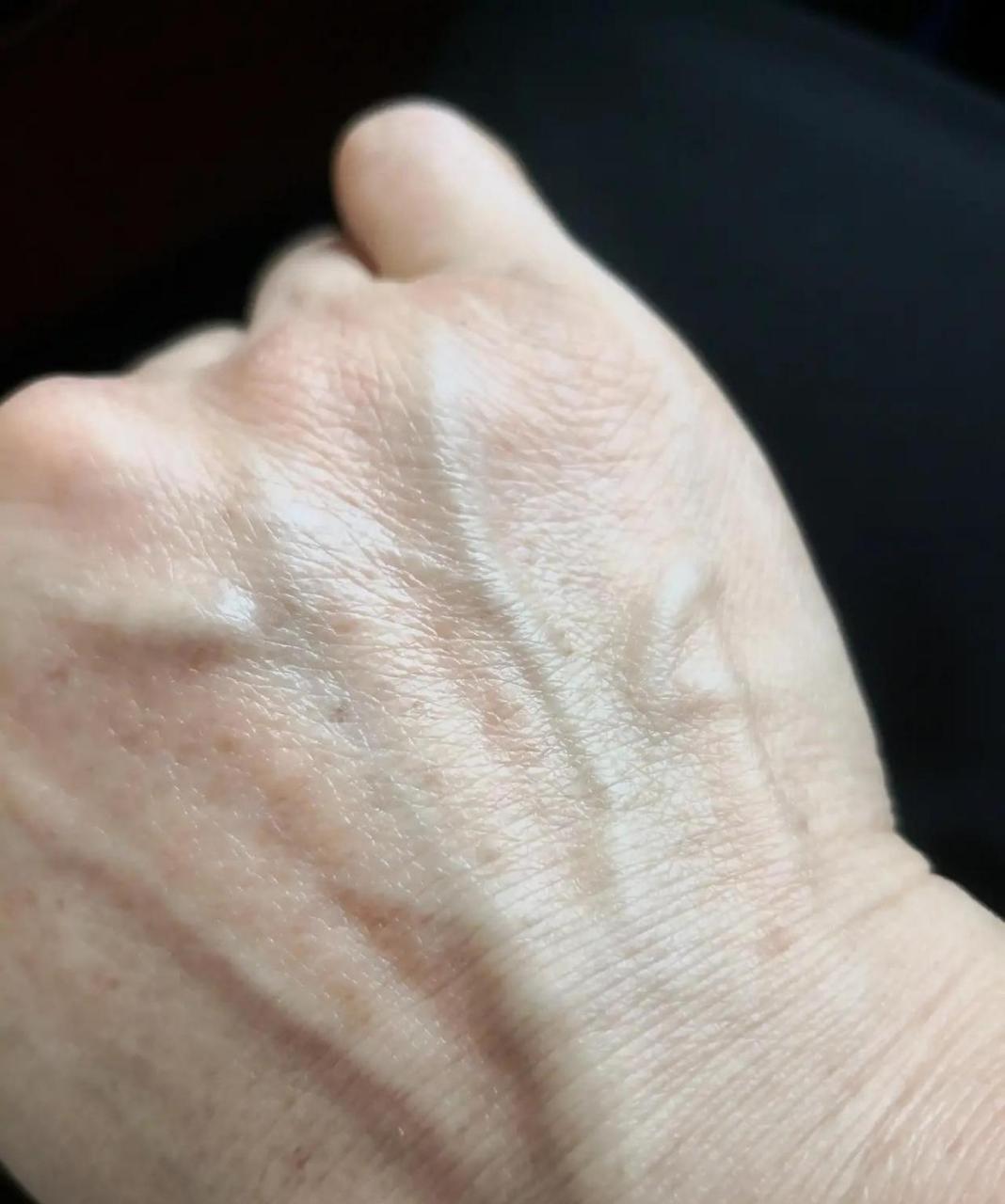 我还不到40岁,手背上就有了很多老年斑.