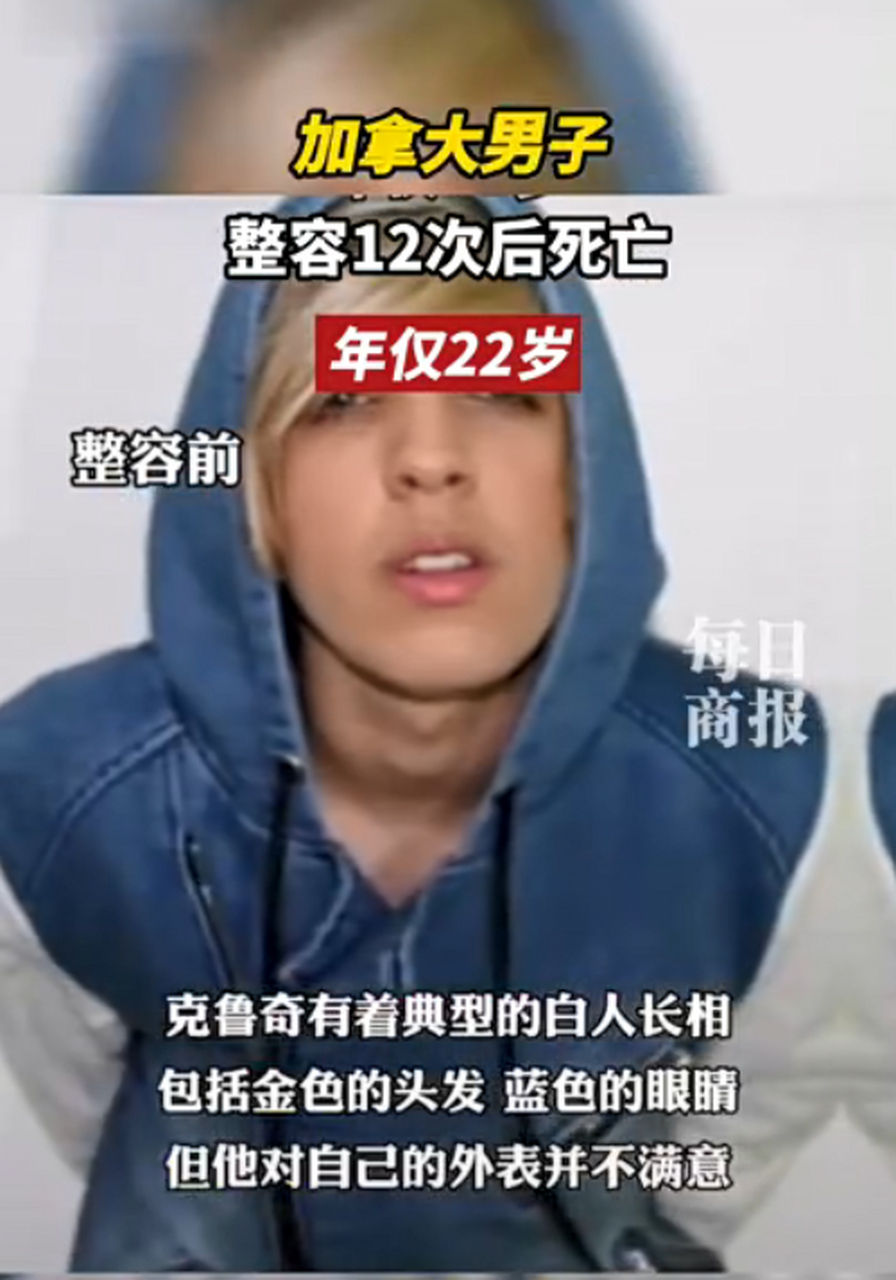 22岁白人男演员12次整形手术后死亡