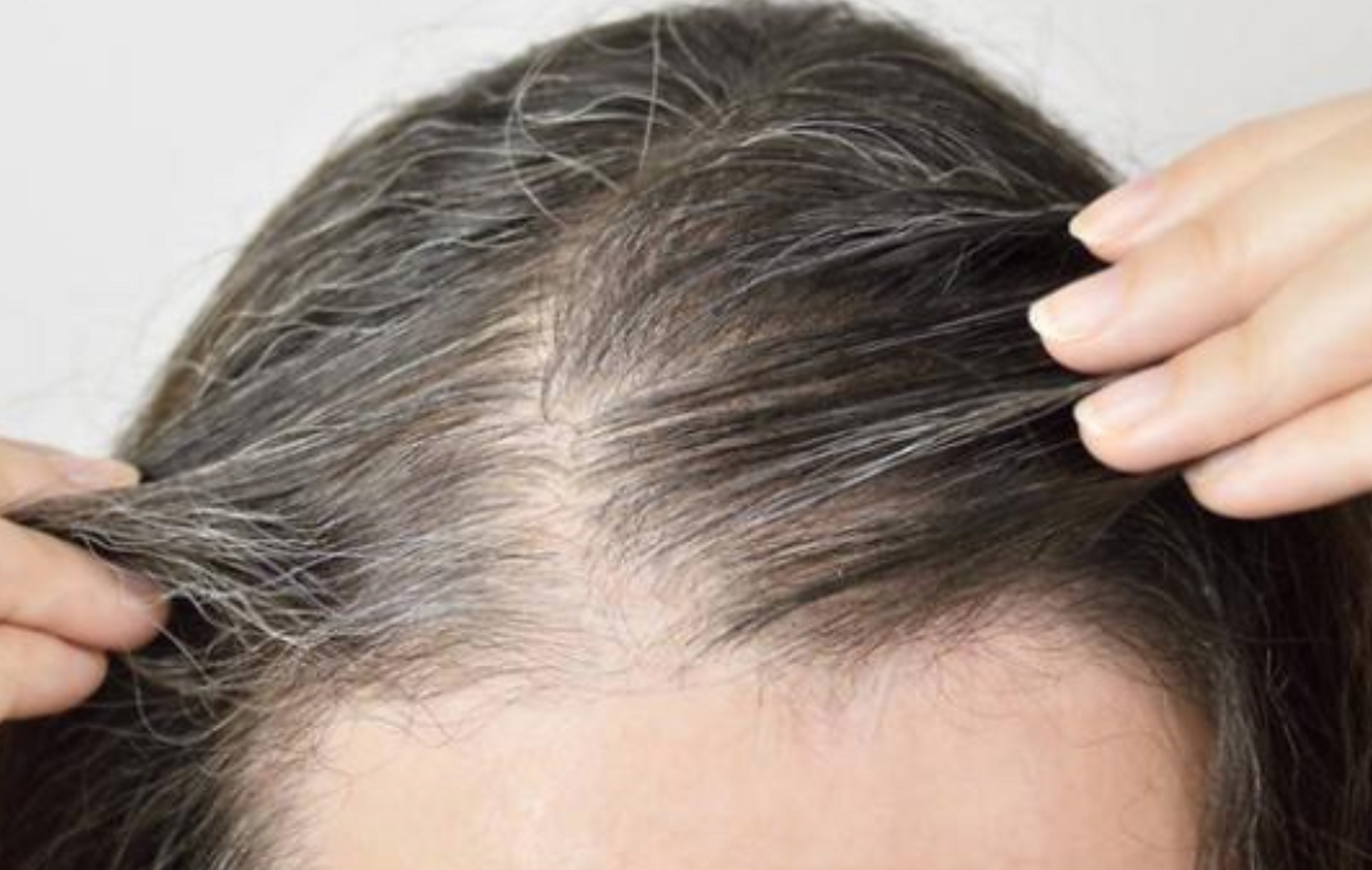 30岁长白发,注意是身体在发出警告  1,头顶白发——气血不足 头顶穴位