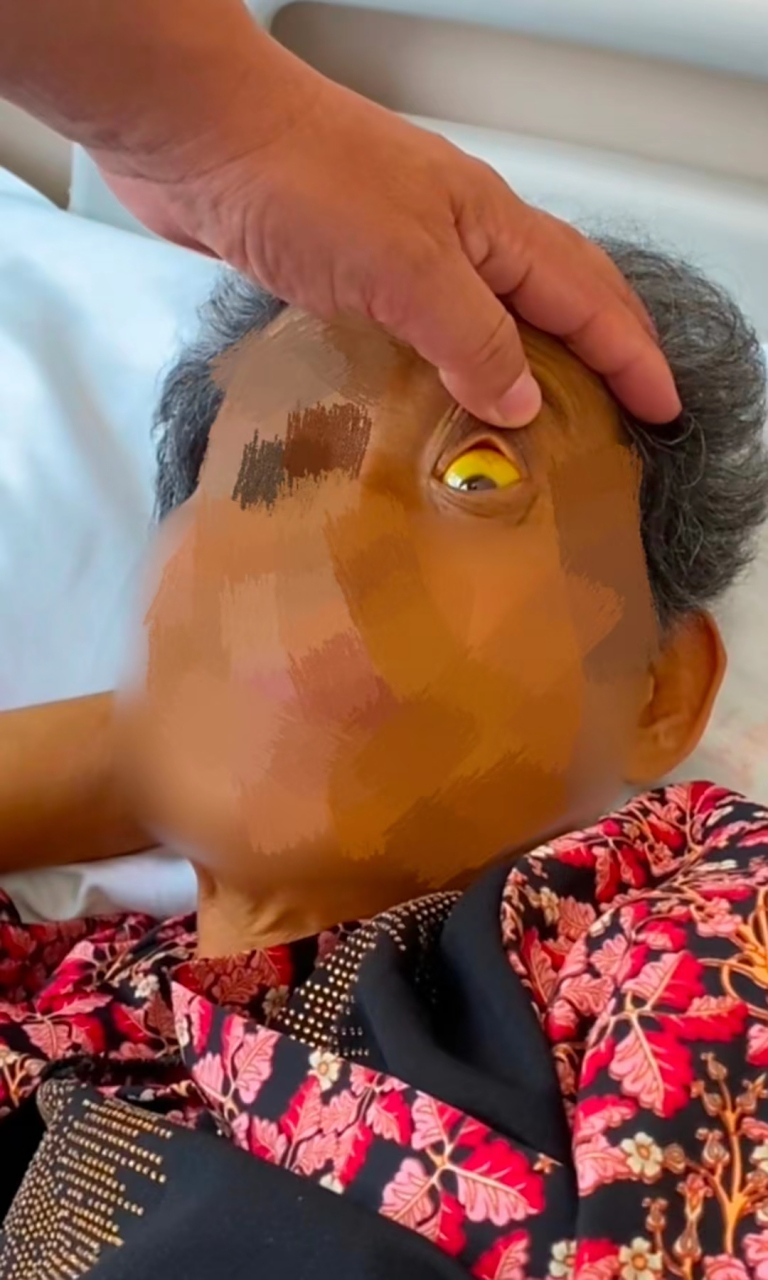 又是一位重症患者,肝硬化腹水,还严重黄疸!