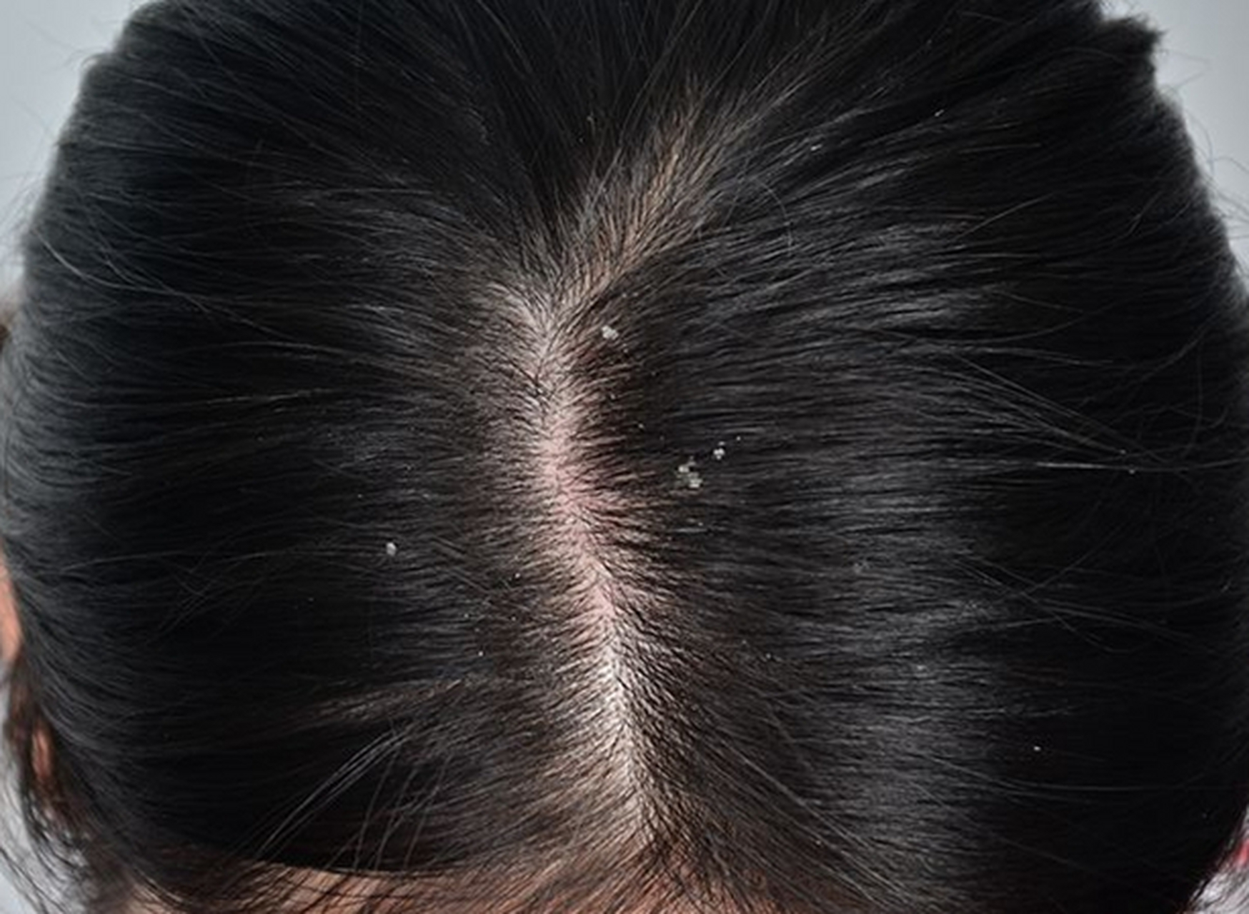 最近发现自己的头发变得越来越油,而且还出现了一些头皮屑.