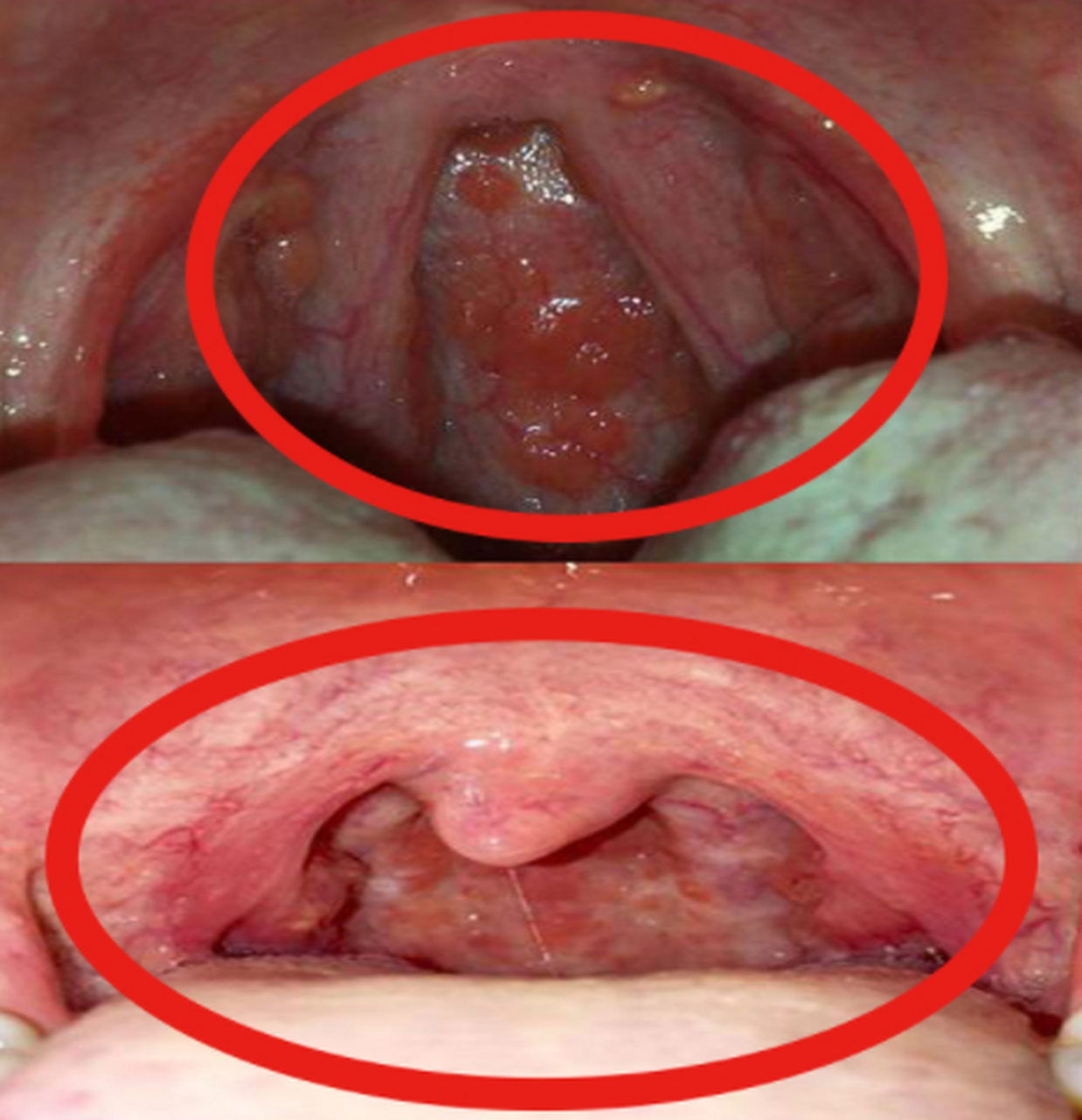 出现淋巴滤泡增生  你会有这些表现: 1.