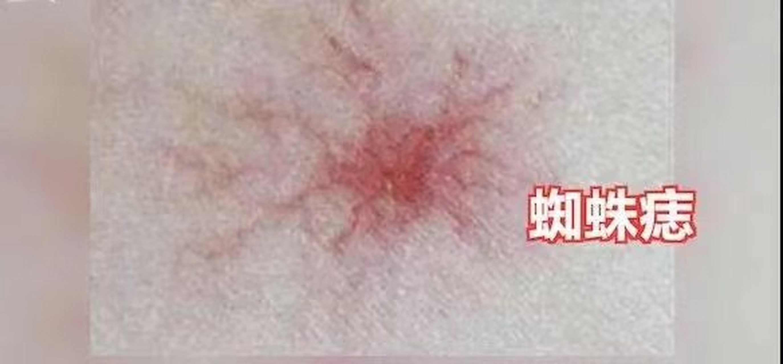 发现蜘蛛痣就是肝硬化吗? 病人甲:"我现在长了这种蜘痣了,吓死人了,我