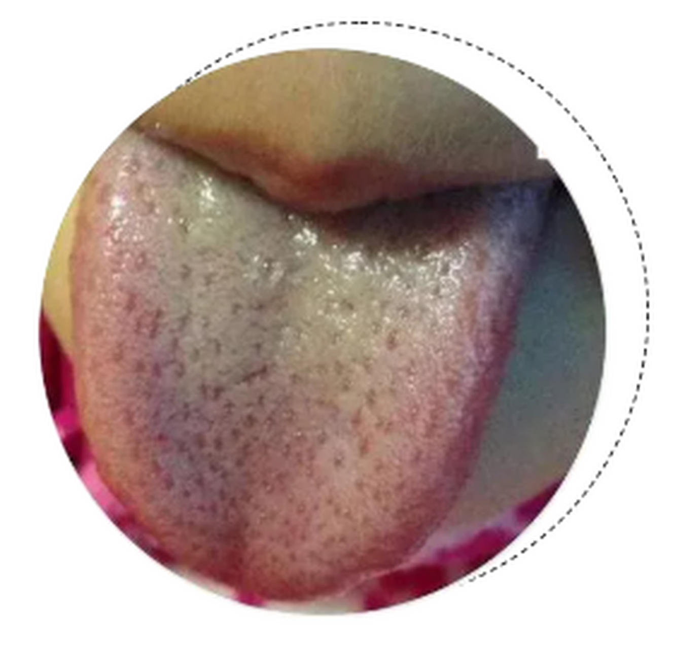 有的黄腻苔也不能清热,温阳祛湿也是一个思路  大家都知道苔腻多是说