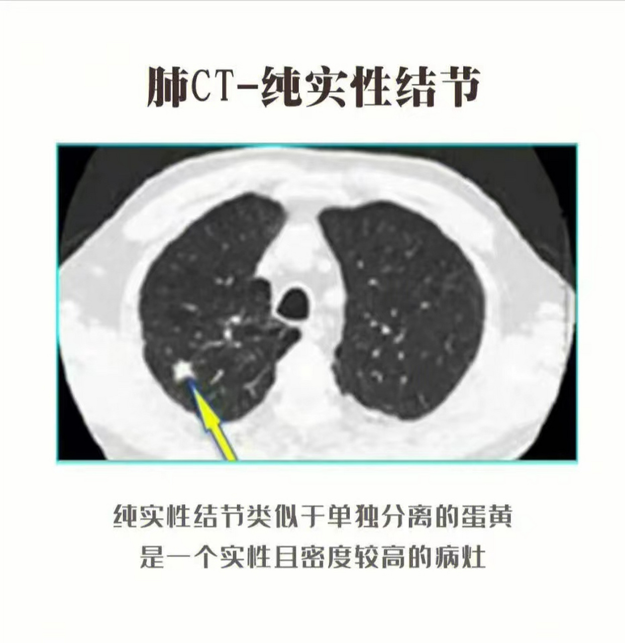 实性肺结节的恶性征象,跟混合磨玻璃结节有很多重叠 1,分叶毛刺 2