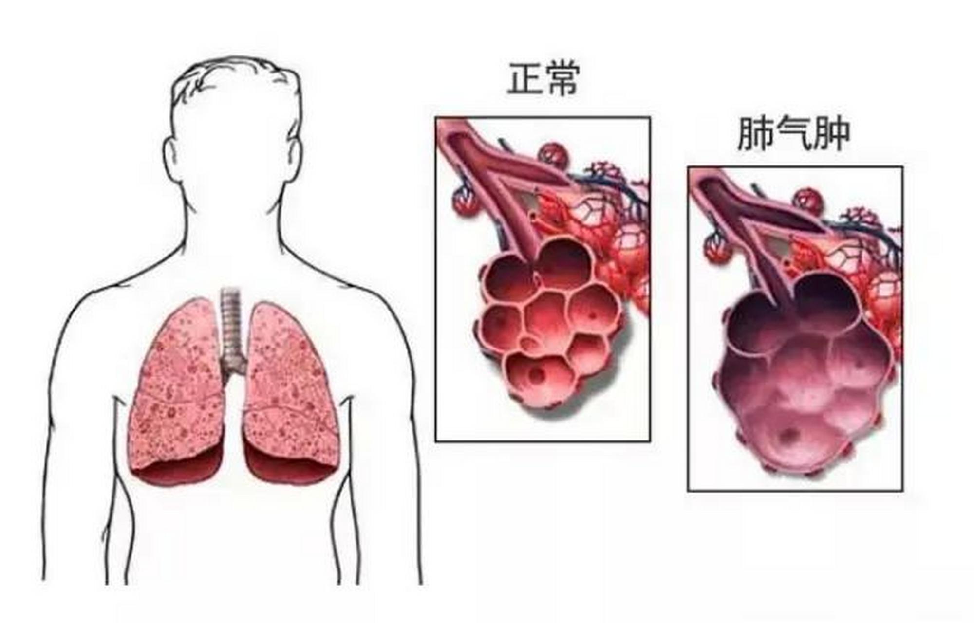 肺气肿常见并发症(一),自发性气胸:自发性气胸并发于阻塞性肺气肿者并