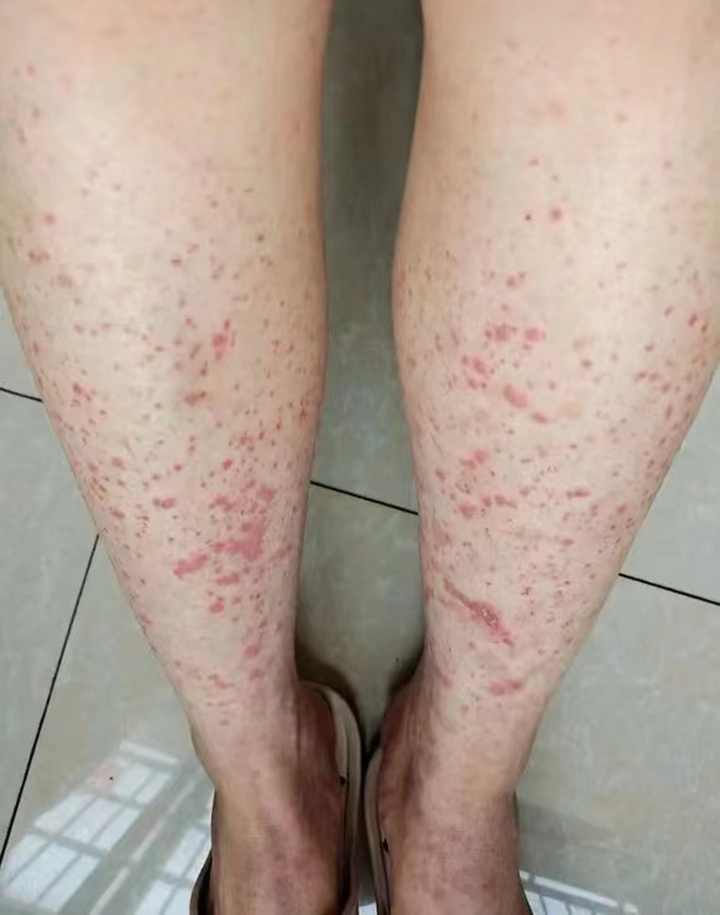 慢性复发性过敏性紫癜,一般多因脾胃虚寒,中气不足,气虚不摄,脾不统