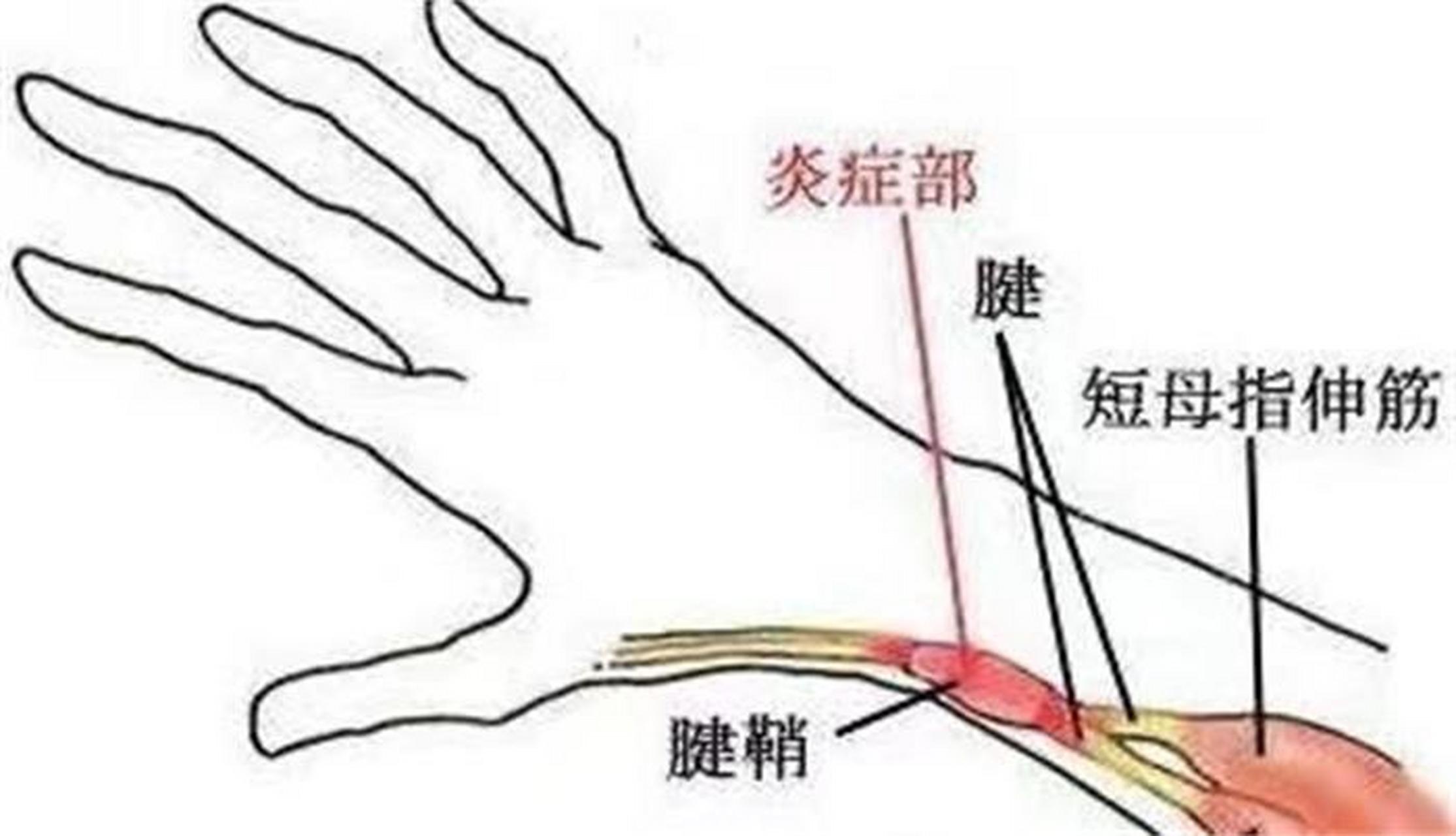 手指僵硬,疼痛!被腱鞘炎缠上的朋友都来试这个方法!