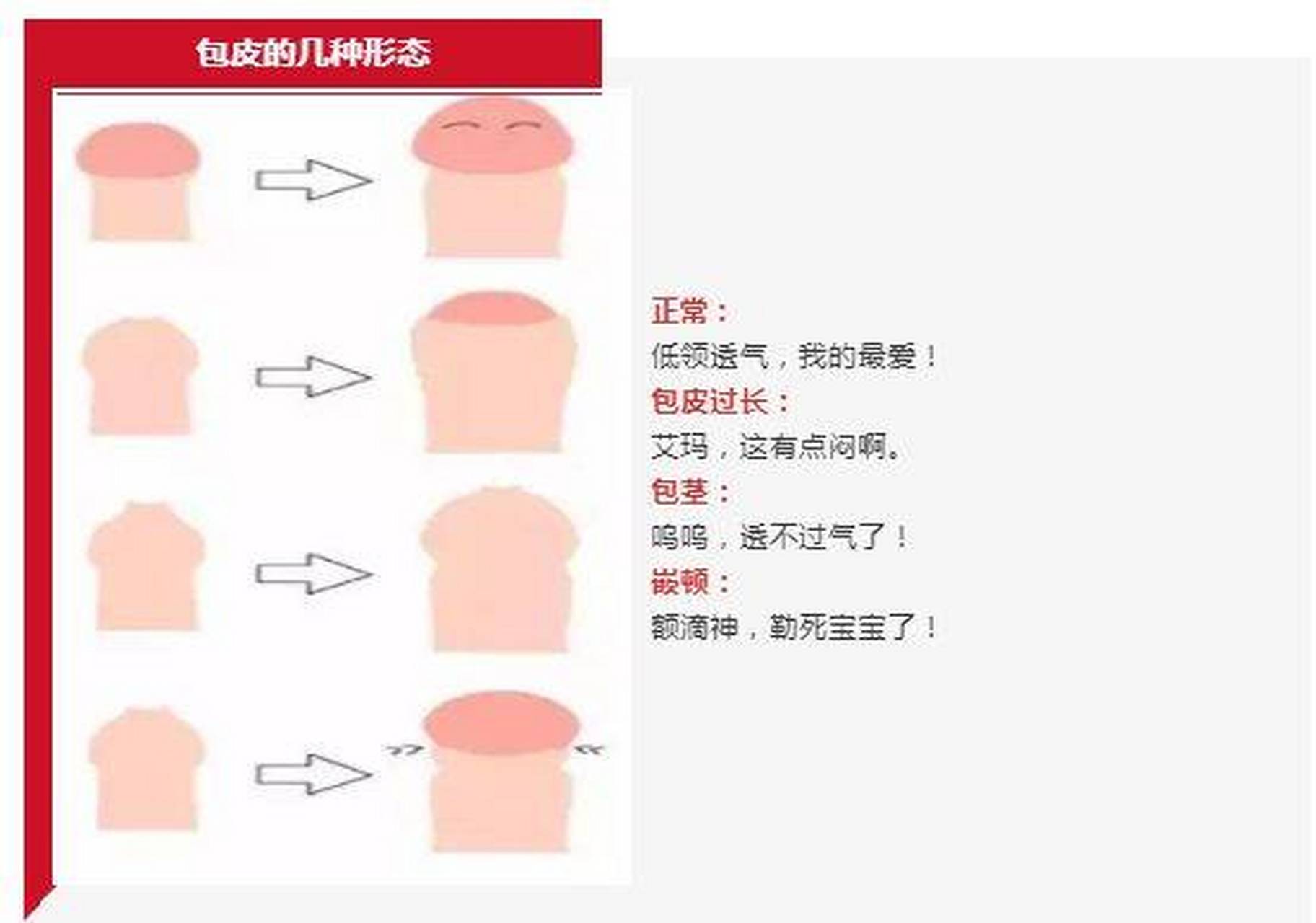 嵌顿包茎 症状图片