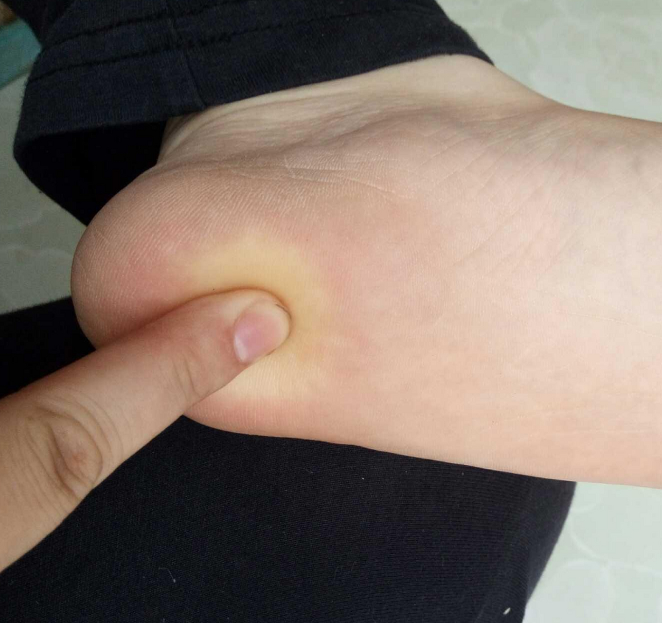 足跟痛怎么去解决它?