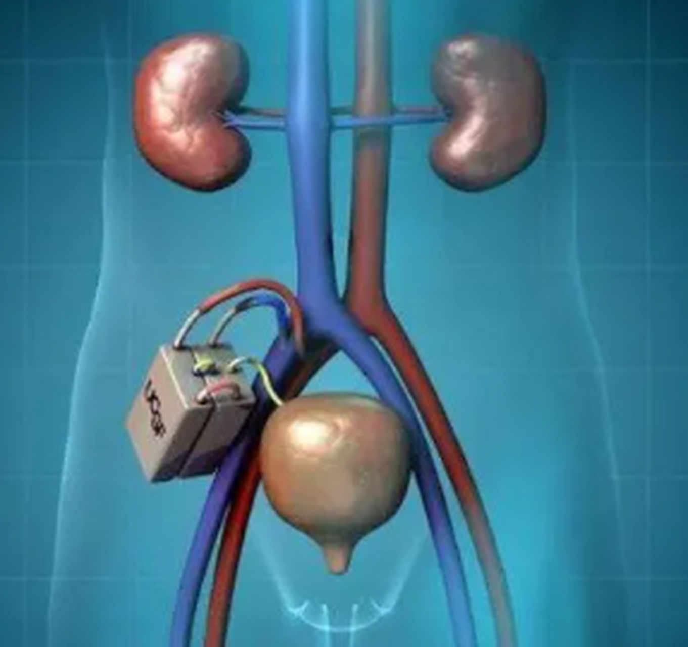 人工肾脏就是机械肾,就是我们用机械这样一种方法去替代我们肾脏的