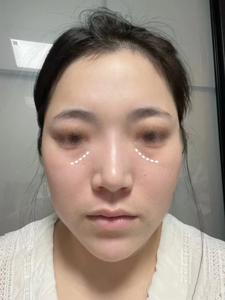 下眼袋突然肿胀,可能是下眼睑局部发炎引起的,可以用眼药水和消炎药
