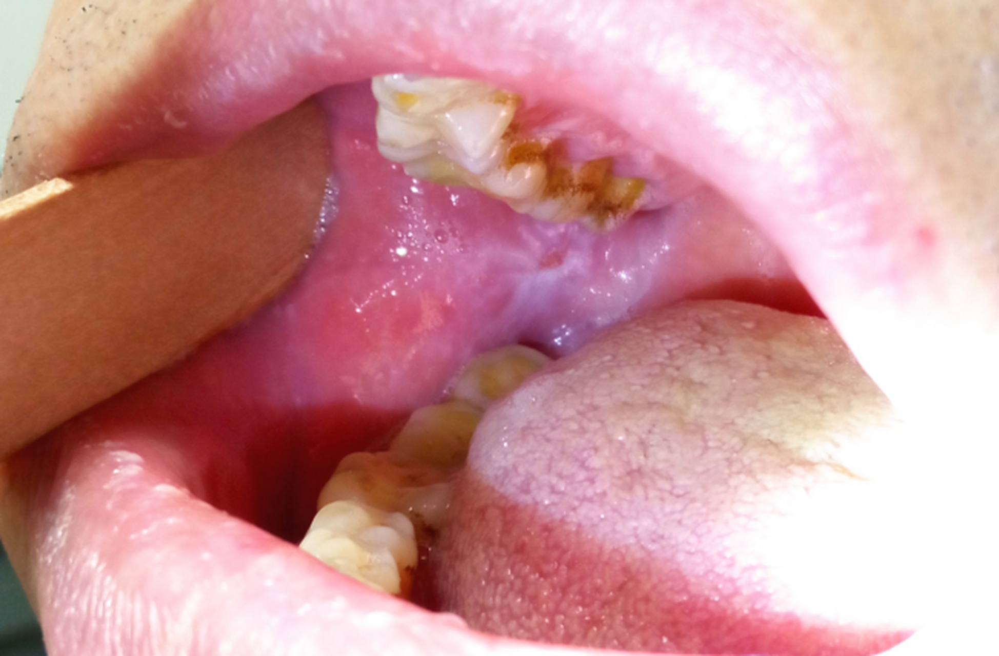 口腔两颊内的溃疡总不好,别傻傻的吃去火药了,可能是这个病.