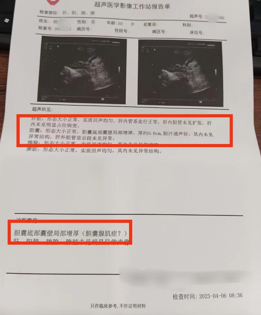 胆囊腺肌症是临床上一种较为常见的胆囊良性疾病,它的发病机制尚不
