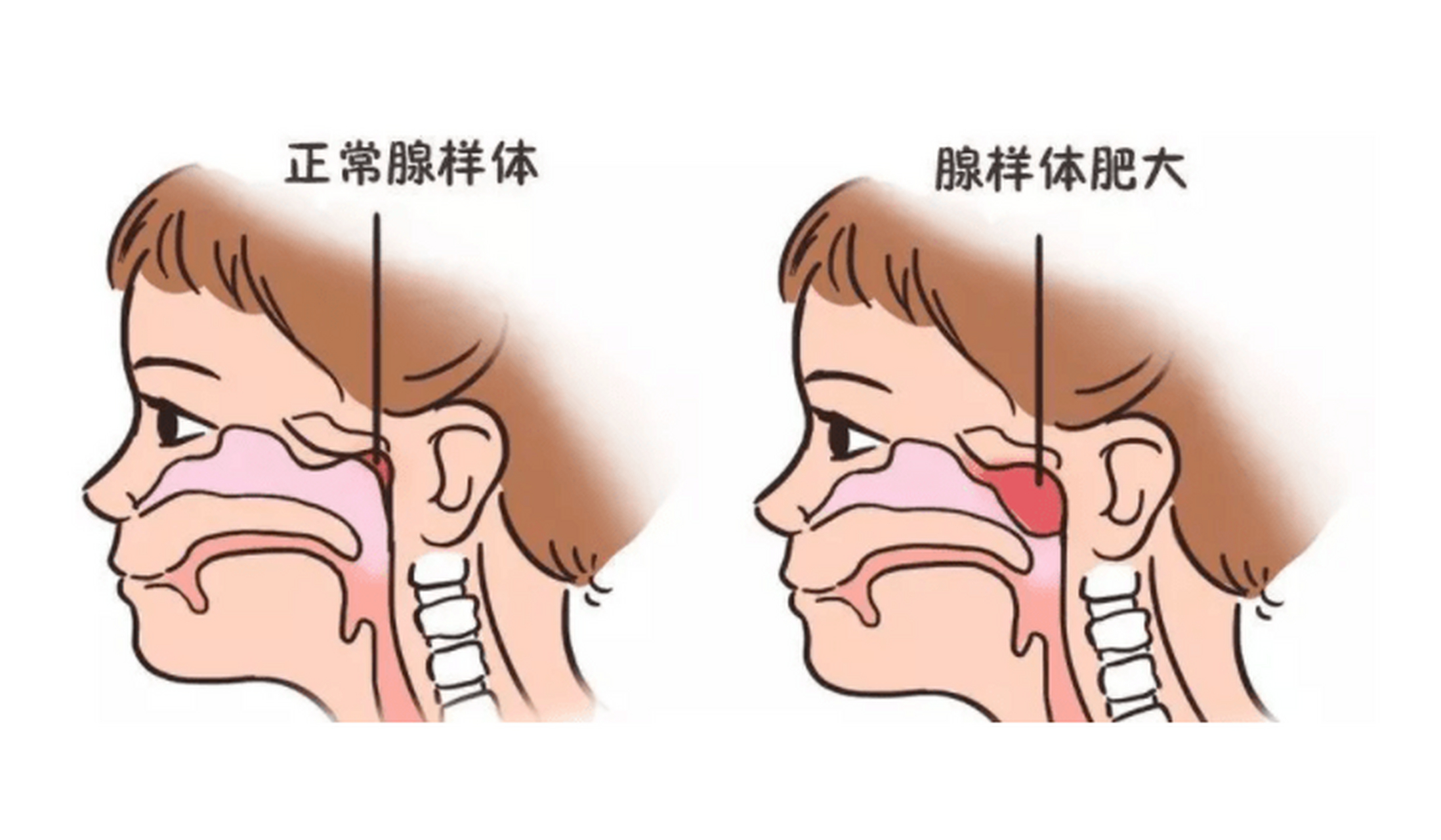 腺样体肥大图片 卡通图片