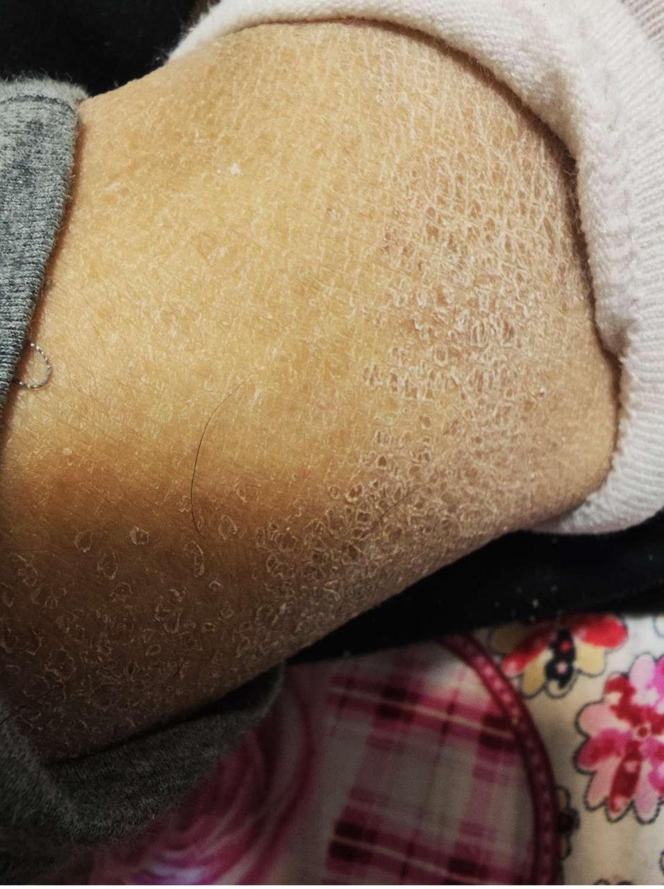 网友:一到冬天身上腿上起皮怎么回事