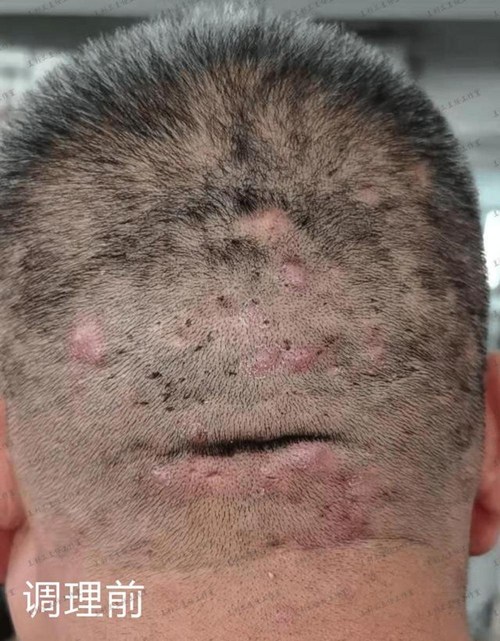 毛囊炎疙瘩,红肿痛痒,一开始只是绿豆粒大小,数量也少,症状轻微稍微用