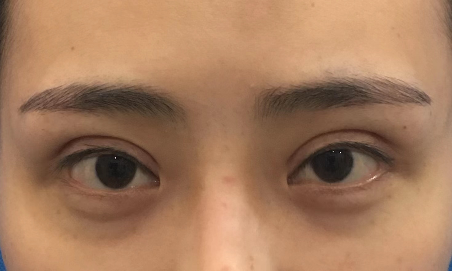 再此提醒大家: ① 眼睛做完后3个月内不要考虑修复的问题,3-6个月要