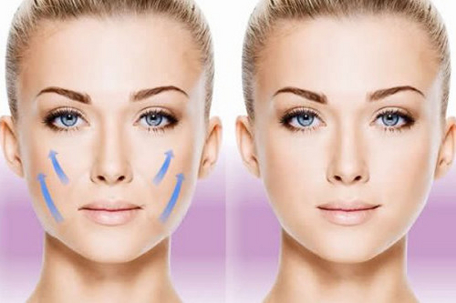 小切口拉皮手术可以维持多久?