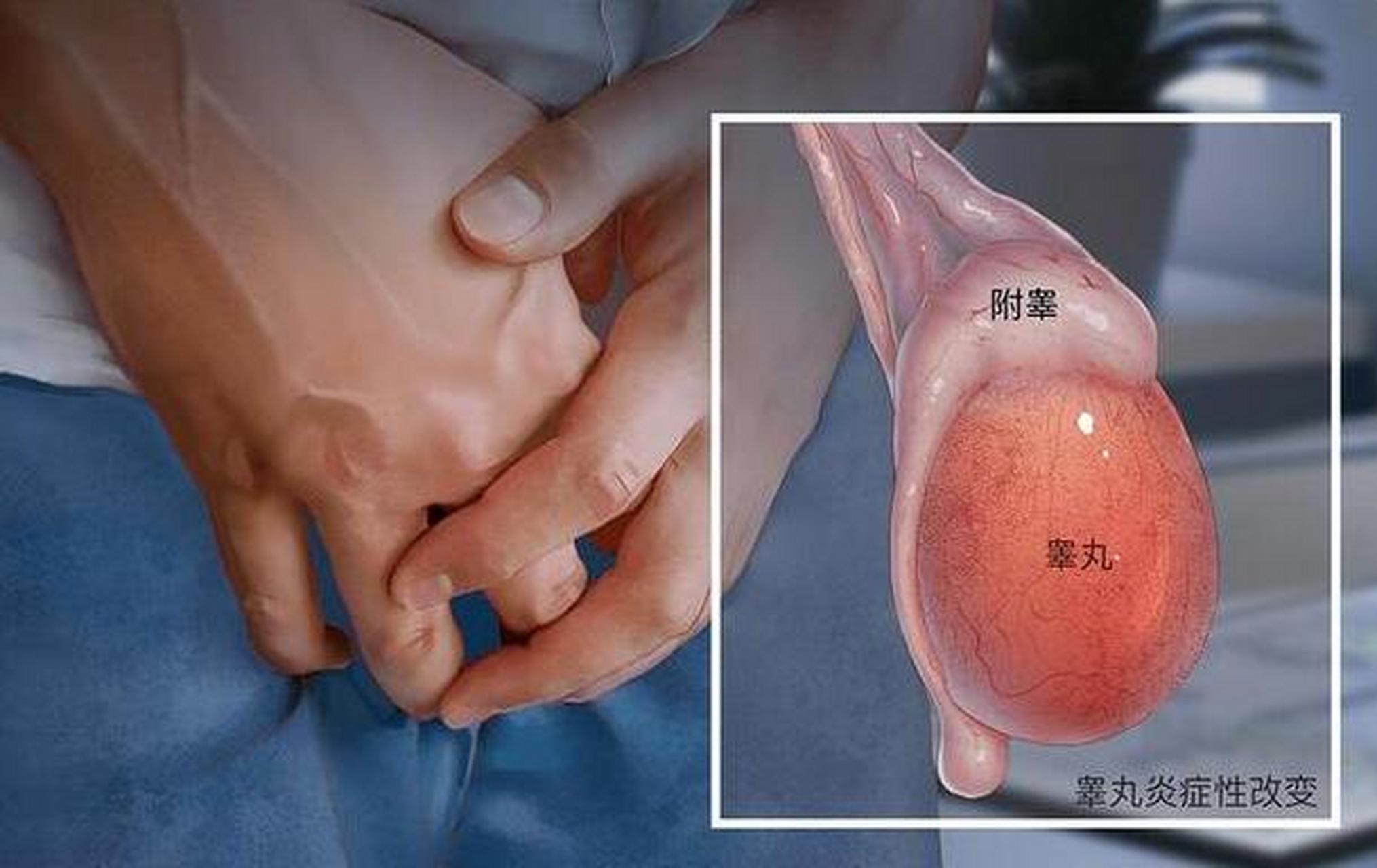 什么是睾丸炎    睾丸炎是男性泌尿生殖系统的睾丸被细菌或病毒