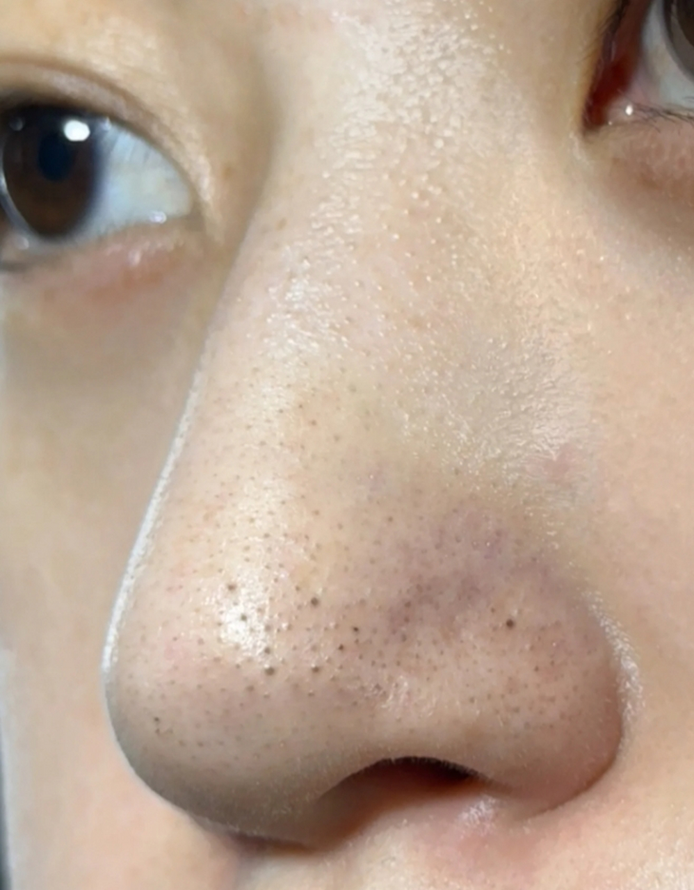 鼻子上的黑头怎么永久去掉是很多人都面临的问题,尽管它们不会对健康