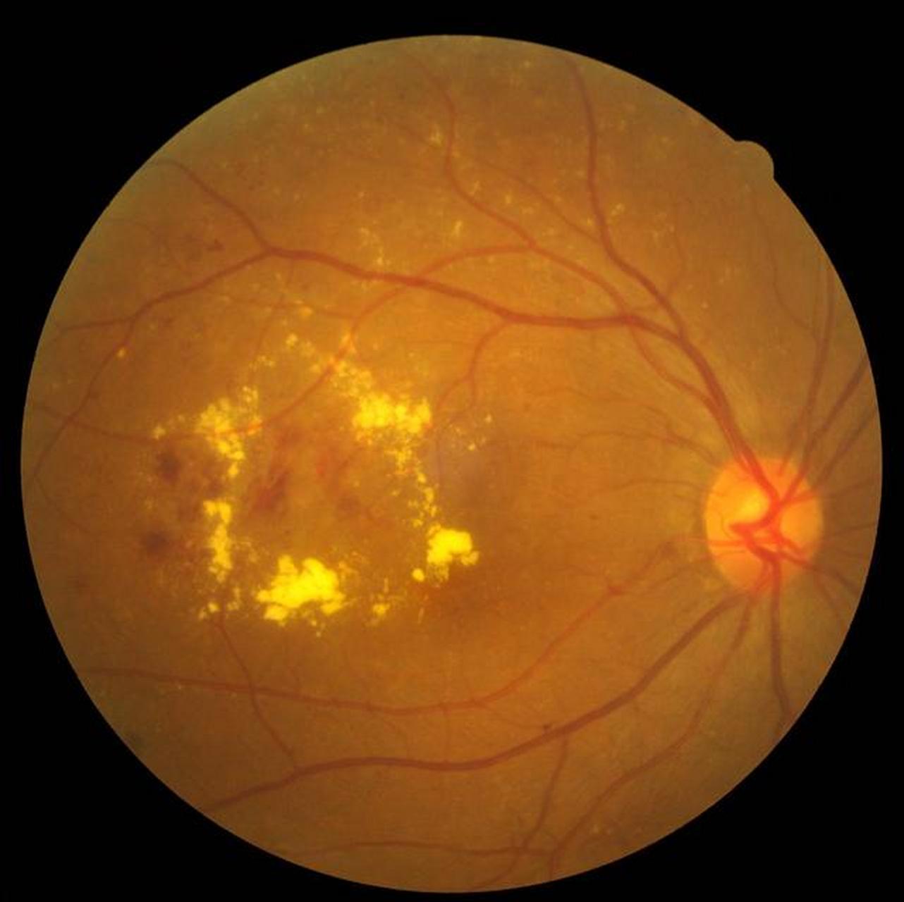 糖尿病引起眼睛并发症,这是控制病情的关键 很多糖尿病患者引起眼部