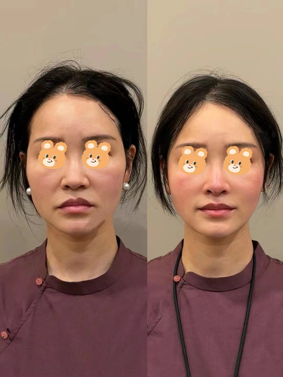 快看,这个女人原本太阳穴凹陷,苹果肌下垂,法令纹也很深,甚至还有口角