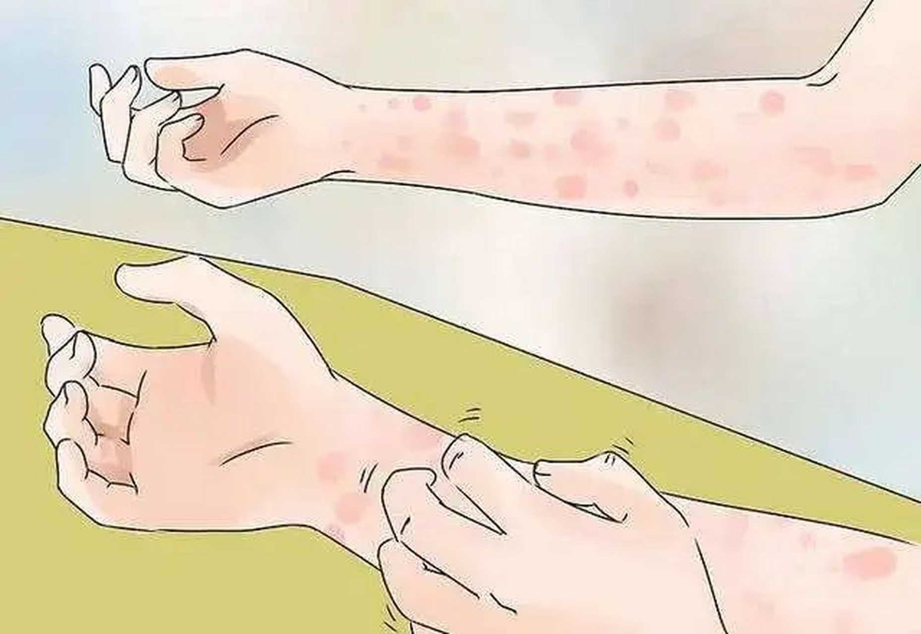 神经性皮炎它是一种局限性的皮肤神经功能障碍性皮肤病,常常以瘙痒和