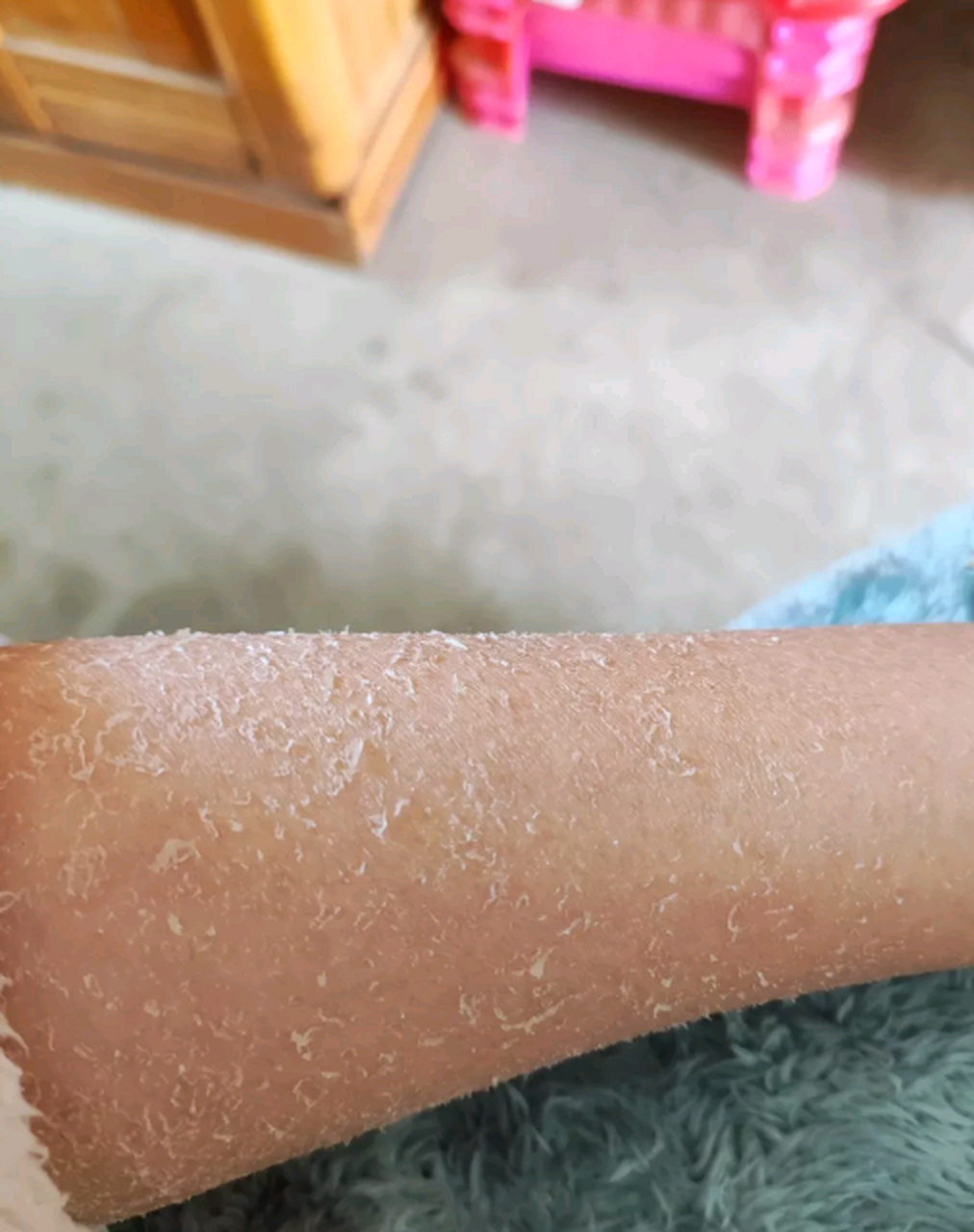 为什么一到冬天,皮肤就一层一层的起皮?