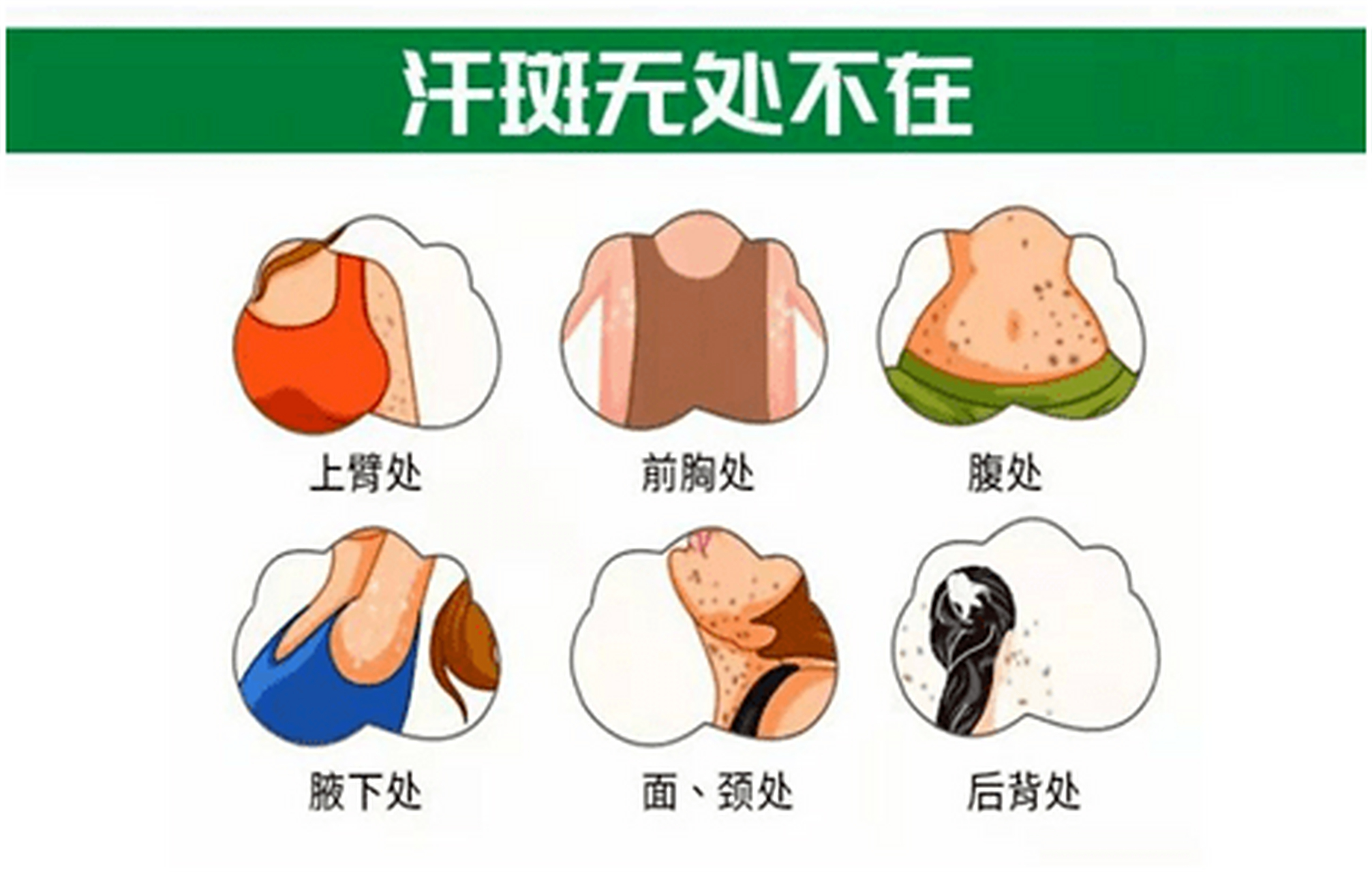 花斑癣#花斑癣# #汗斑# #汗斑治疗#  花斑癣也叫汗斑,一种表皮真菌