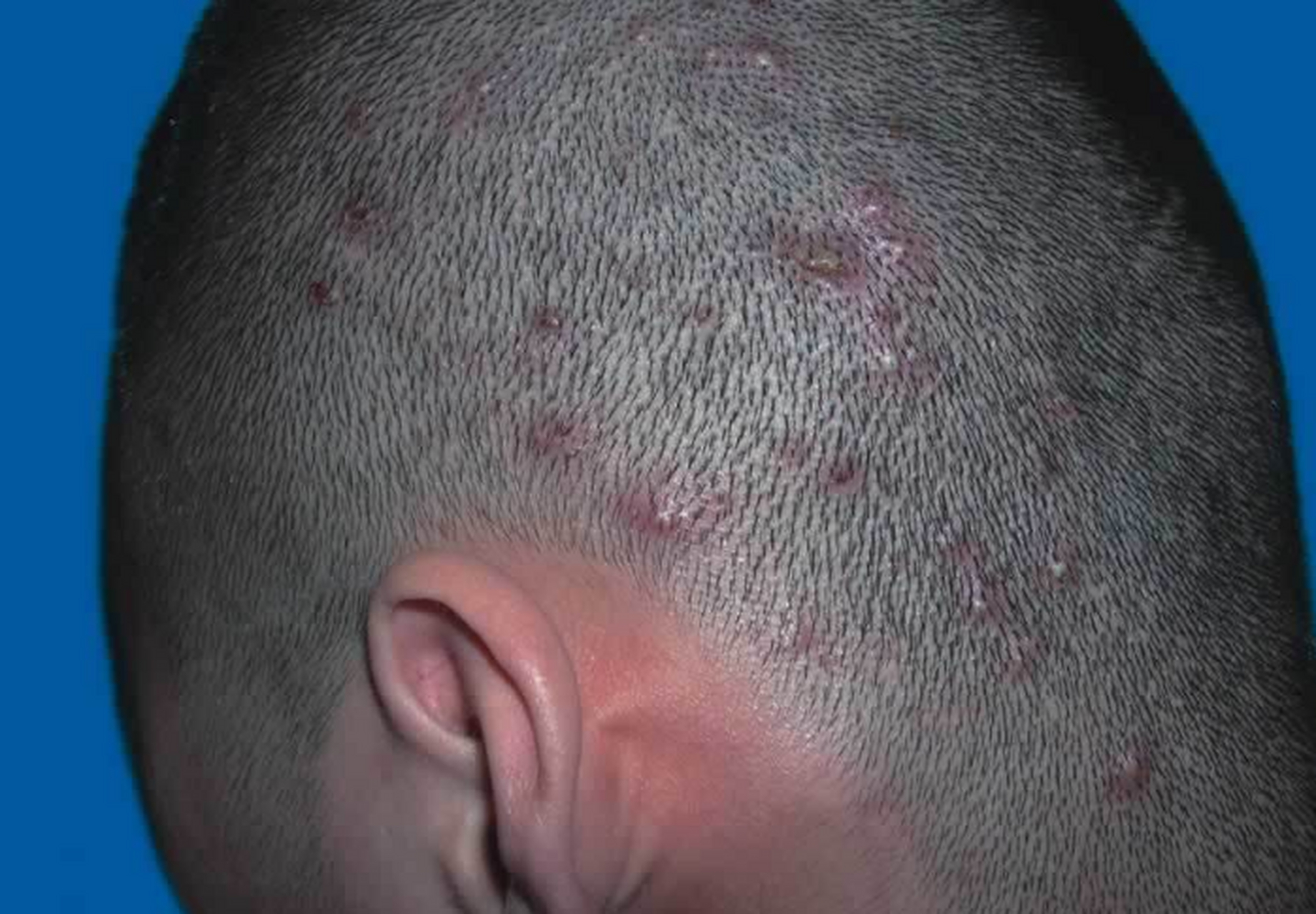 尤其是在换季时,头皮屑会变得更加严重,让我感到非常尴尬和不自在.