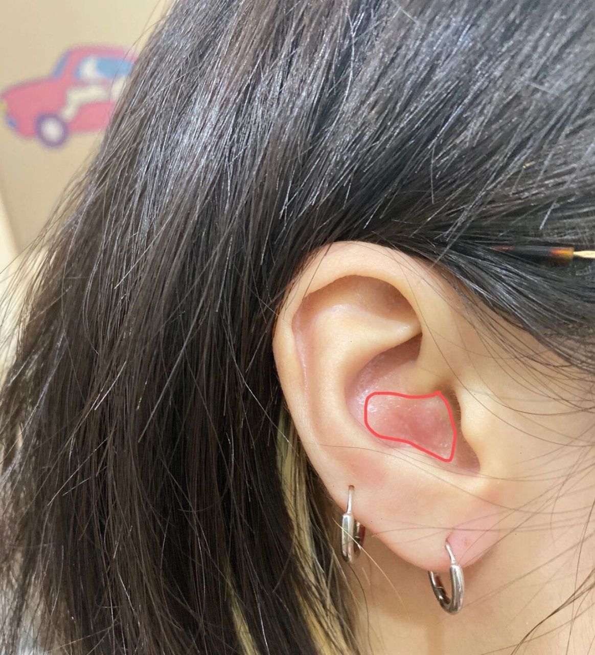 耳朵里长了个包	  有谁知道我画的红色区域长了个包是怎么了嘛 按压